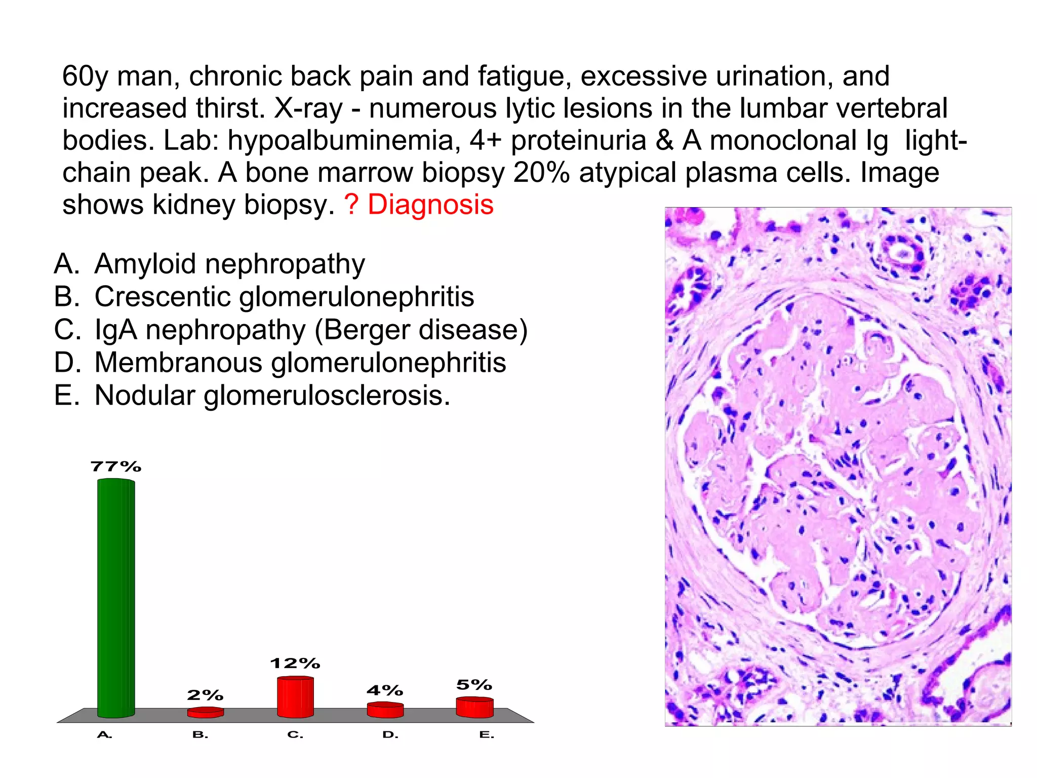 60y man, chronic back pain and fatigue, excessive urination, and increased thirst. X-ray - numerous lytic lesions in the lumbar vertebral bodies. Lab: hypoalbuminemia, 4+ proteinuria & A monoclonal Ig  light-chain peak. A bone marrow biopsy 20% atypical plasma cells. Image shows kidney biopsy.  ? Diagnosis Amyloid nephropathy Crescentic glomerulonephritis IgA nephropathy (Berger disease) Membranous glomerulonephritis Nodular glomerulosclerosis. 