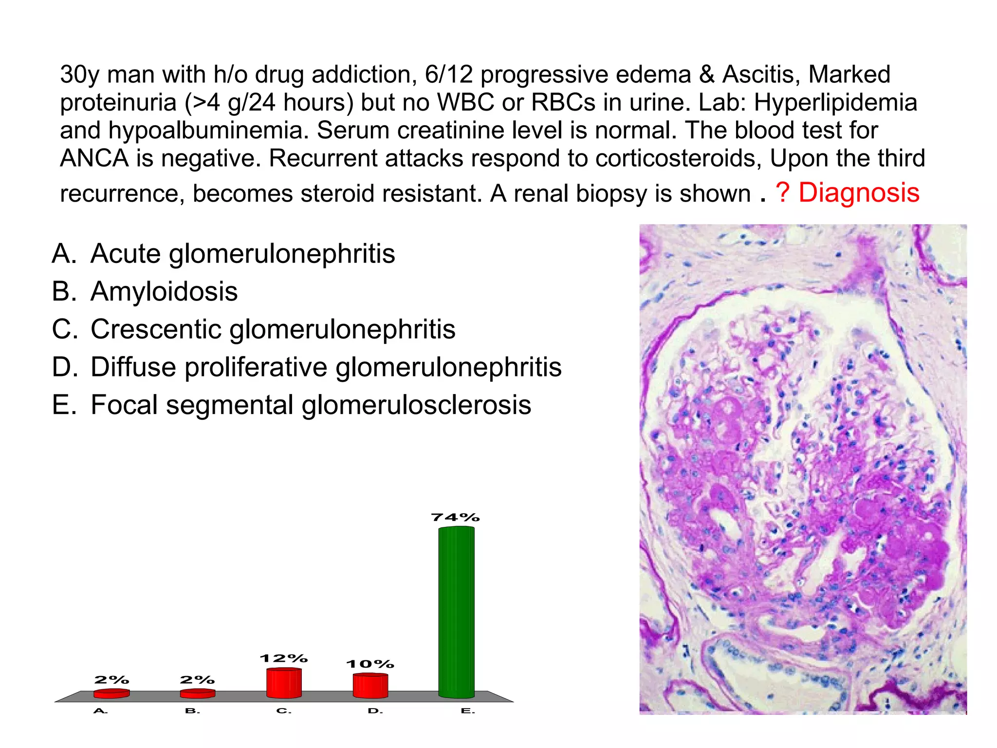 30y man with h/o drug addiction, 6/12 progressive edema & Ascitis, Marked proteinuria (>4 g/24 hours) but no WBC or RBCs in urine. Lab: Hyperlipidemia and hypoalbuminemia. Serum creatinine level is normal. The blood test for ANCA is negative. Recurrent attacks respond to corticosteroids, Upon the third recurrence, becomes steroid resistant. A renal biopsy is shown  .   ? Diagnosis Acute glomerulonephritis Amyloidosis Crescentic glomerulonephritis Diffuse proliferative glomerulonephritis Focal segmental glomerulosclerosis 