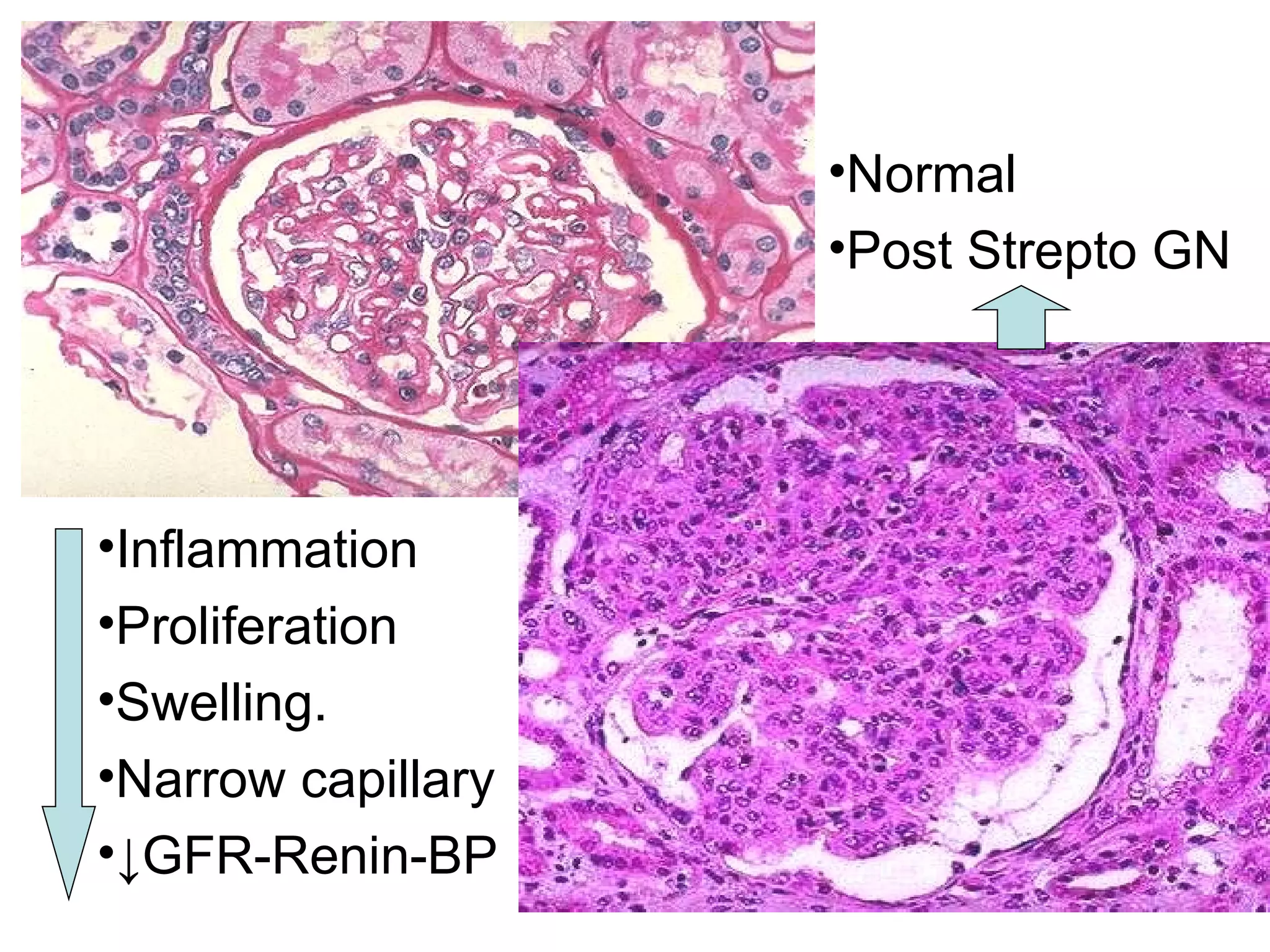Normal Post Strepto GN Inflammation Proliferation Swelling. Narrow capillary ↓ GFR-Renin-BP 