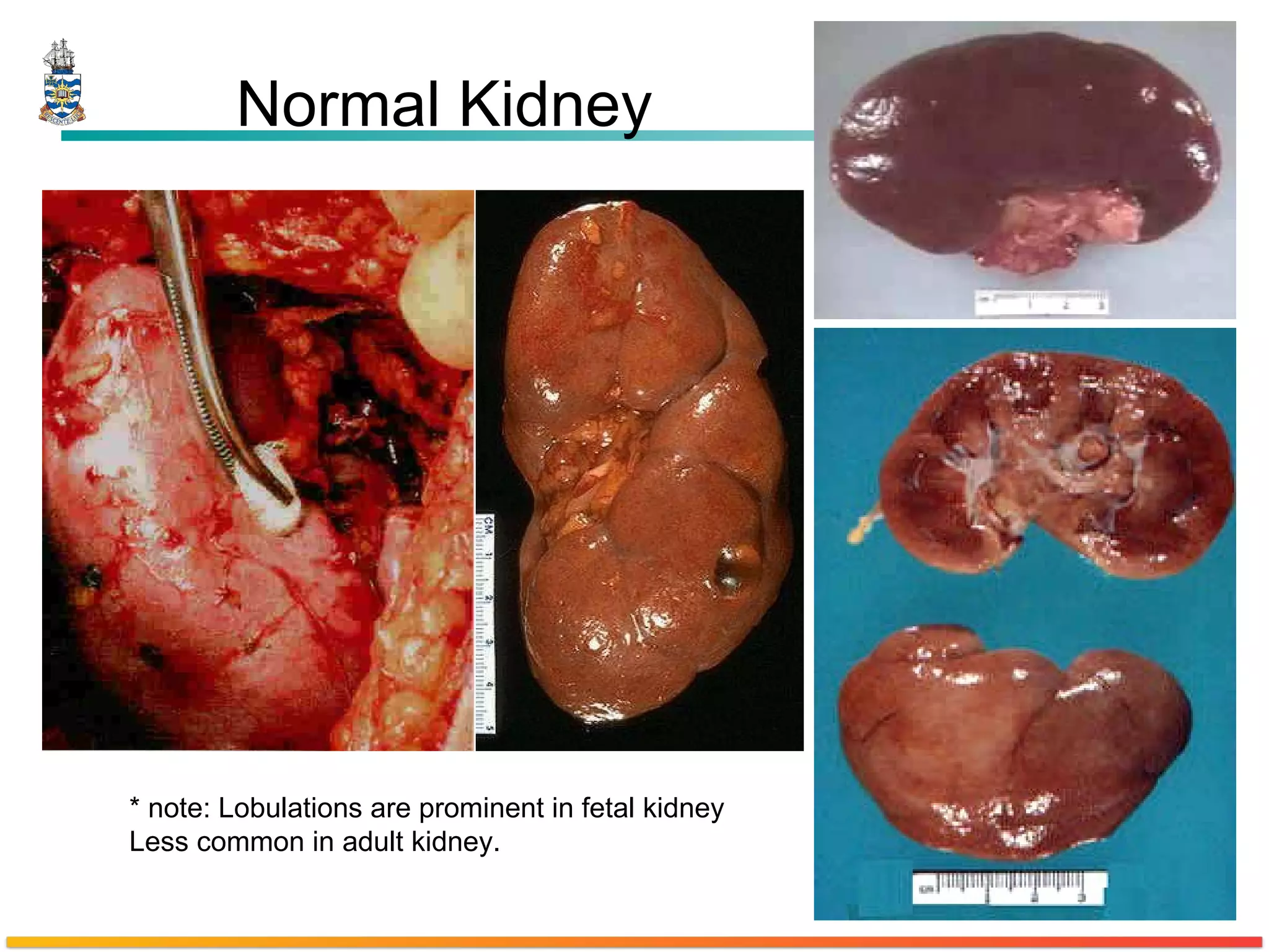 Normal Kidney * note: Lobulations are prominent in fetal kidney  Less common in adult kidney. 