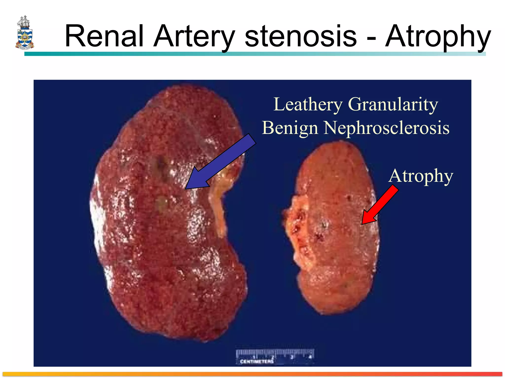 Renal Artery stenosis - Atrophy Leathery Granularity Benign Nephrosclerosis Atrophy 