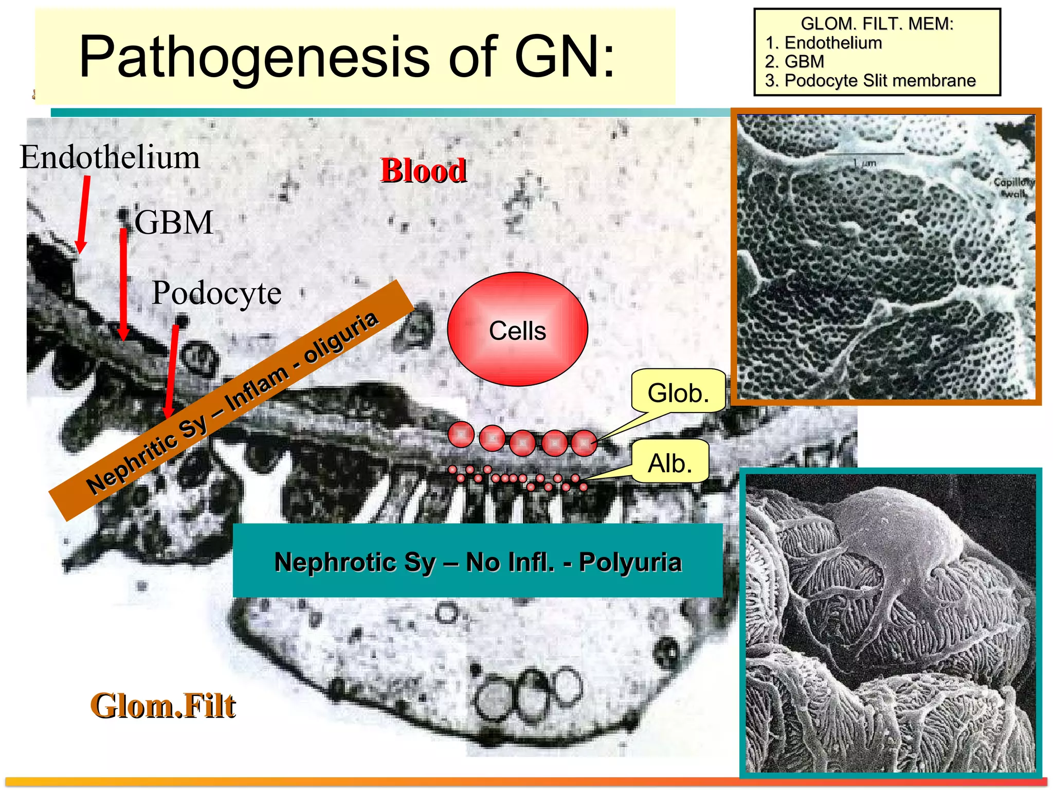 Pathogenesis of GN:  Blood GBM Podocyte GLOM. FILT. MEM: 1. Endothelium 2. GBM 3. Podocyte Slit membrane Endothelium Cells Glom.Filt Glob. Alb. Nephrotic Sy – No Infl. - Polyuria Nephritic Sy – Inflam - oliguria 