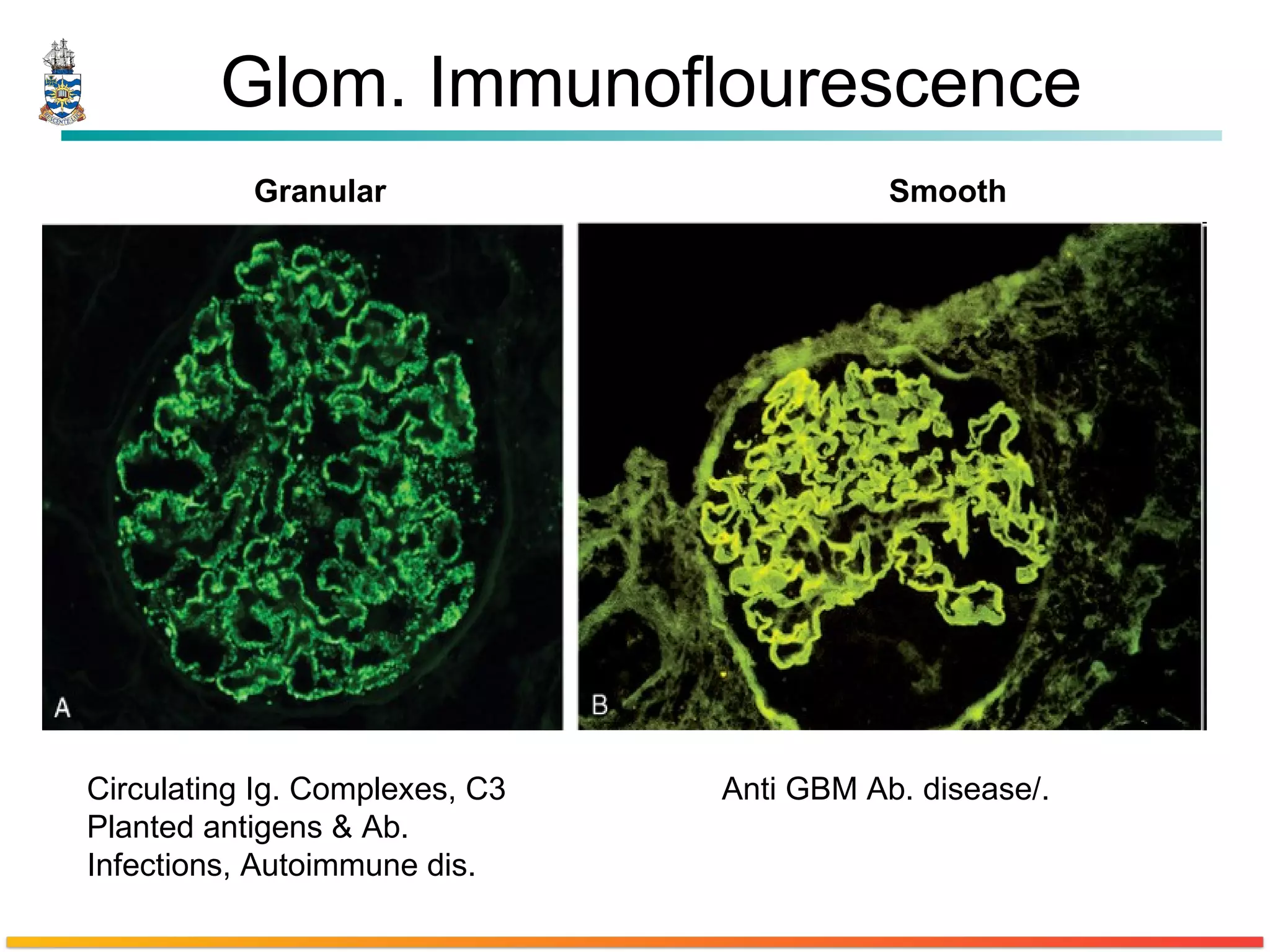 Glom. Immunoflourescence  Granular  Smooth Circulating Ig. Complexes, C3 Anti GBM Ab. disease/. Planted antigens & Ab. Infections, Autoimmune dis. 