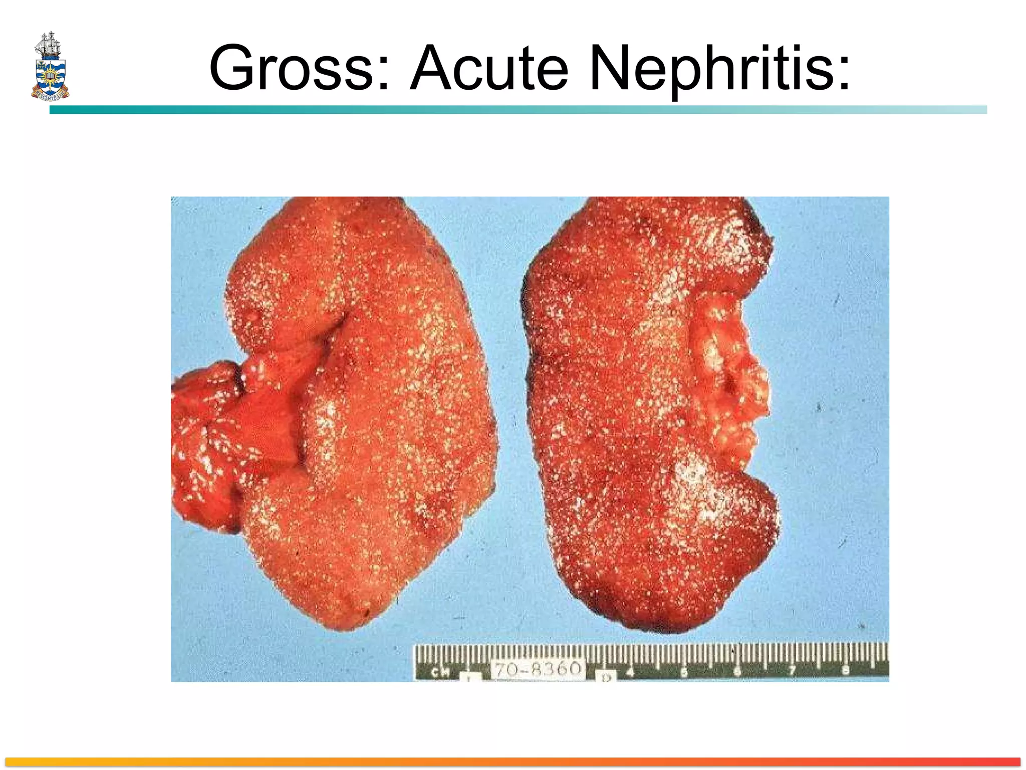 Gross: Acute Nephritis: 