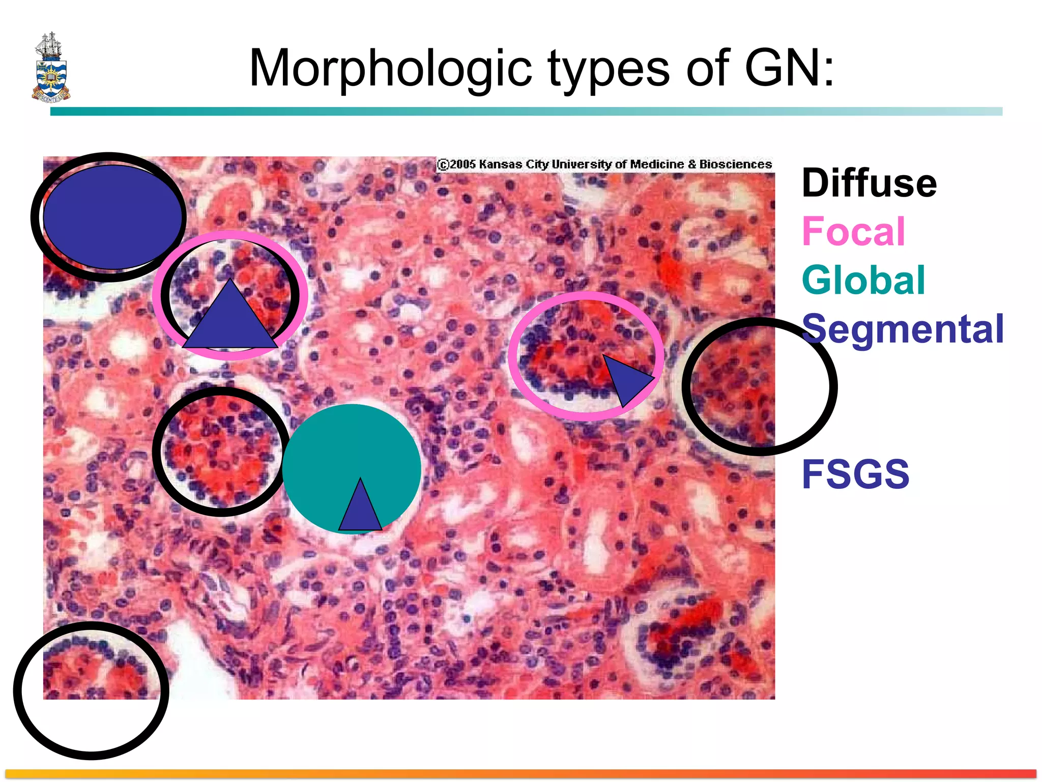 Morphologic types of GN: Diffuse Focal Global Segmental FSGS 