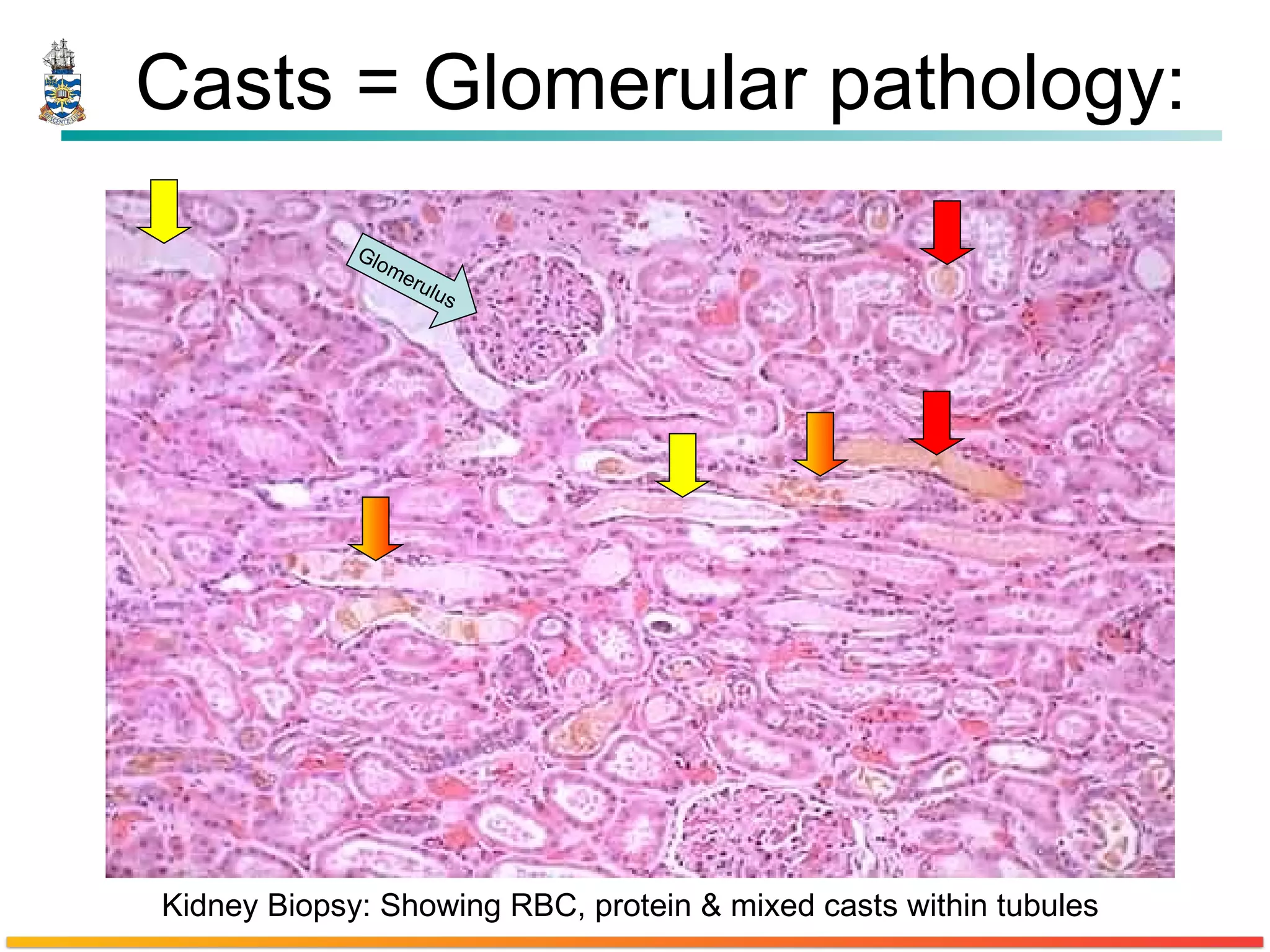 Casts = Glomerular pathology: Kidney Biopsy: Showing RBC, protein & mixed casts within tubules Glomerulus 