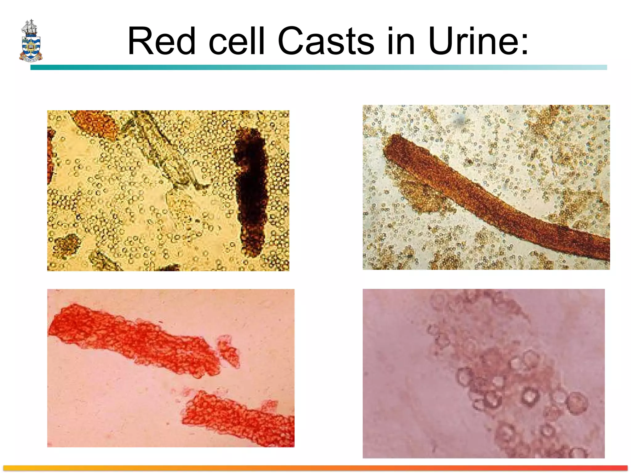 Red cell Casts in Urine: 