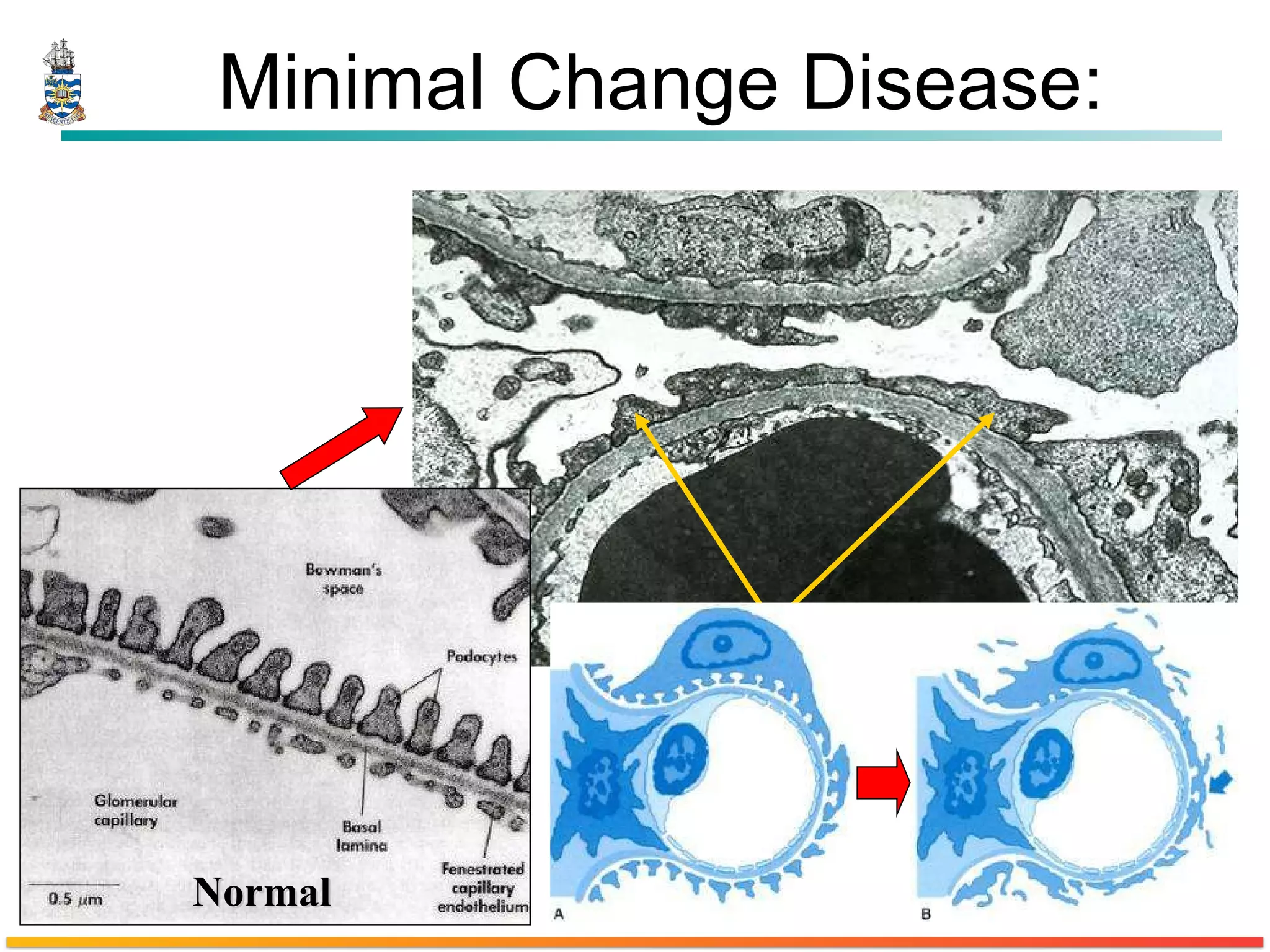 Minimal Change Disease: Loss of Foot processes Normal 