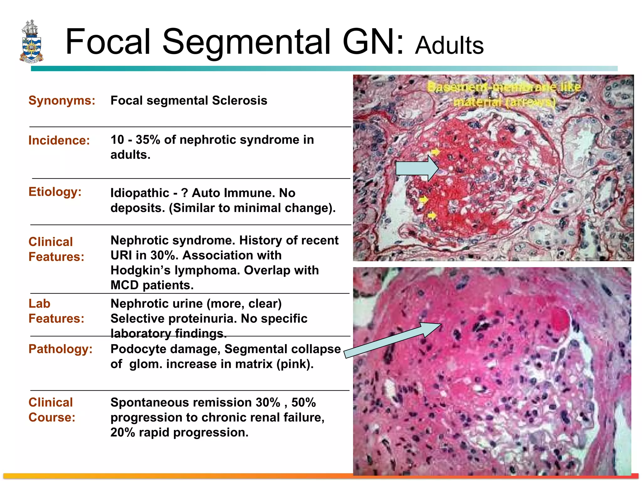 Focal Segmental GN:  Adults Synonyms: Incidence: Etiology: Clinical Features: Lab Features: Pathology: Clinical Course: Focal segmental Sclerosis Idiopathic - ? Auto Immune. No deposits. (Similar to minimal change). Nephrotic syndrome. History of recent URI in 30%. Association with Hodgkin’s lymphoma. Overlap with MCD patients. Nephrotic urine (more, clear) Selective proteinuria. No specific laboratory findings. Spontaneous remission 30% , 50% progression to chronic renal failure, 20% rapid progression. Podocyte damage, Segmental collapse of  glom. increase in matrix (pink).  10 - 35% of nephrotic syndrome in adults. 