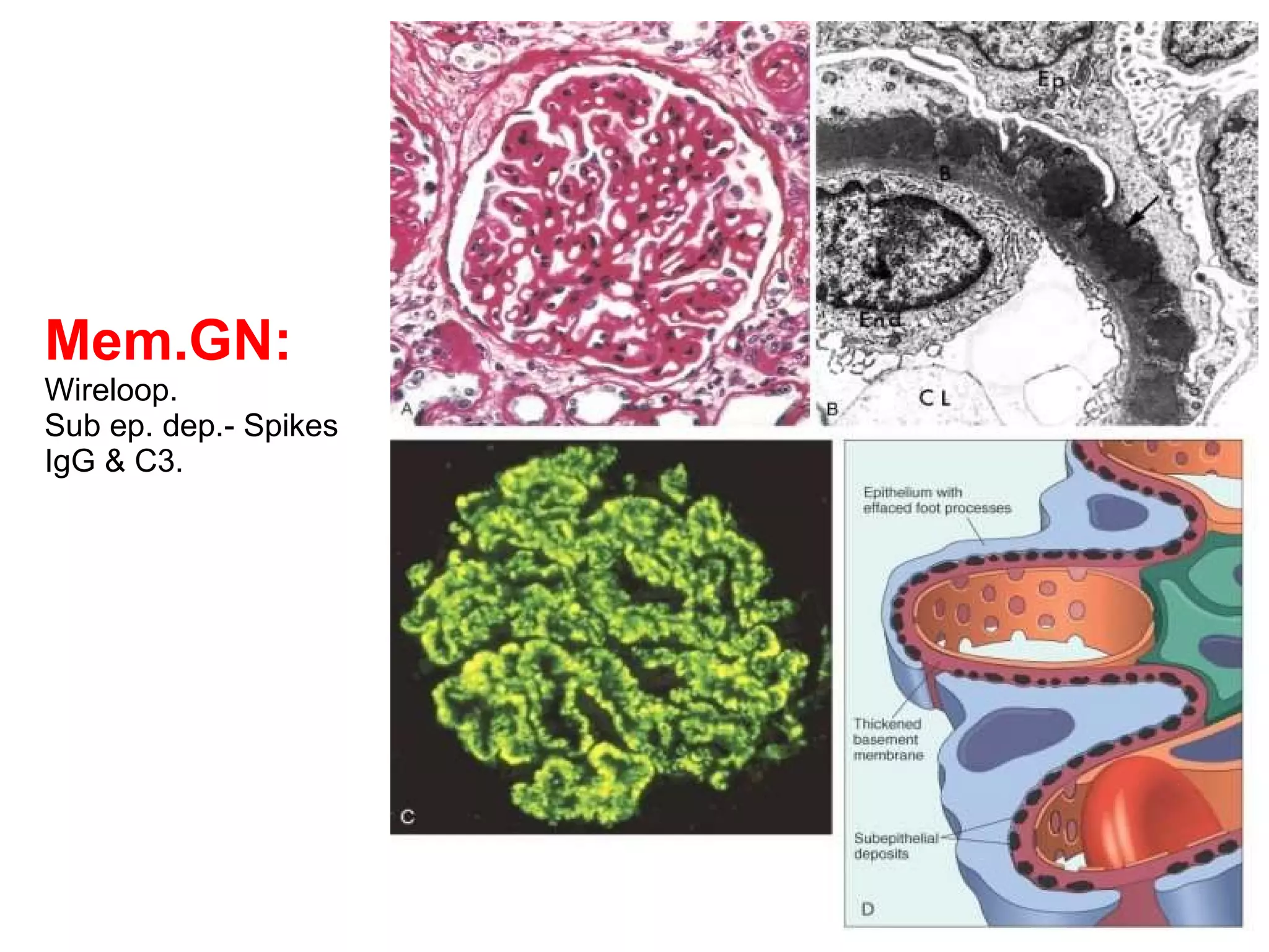 Mem.GN: Wireloop. Sub ep. dep.- Spikes IgG & C3. 
