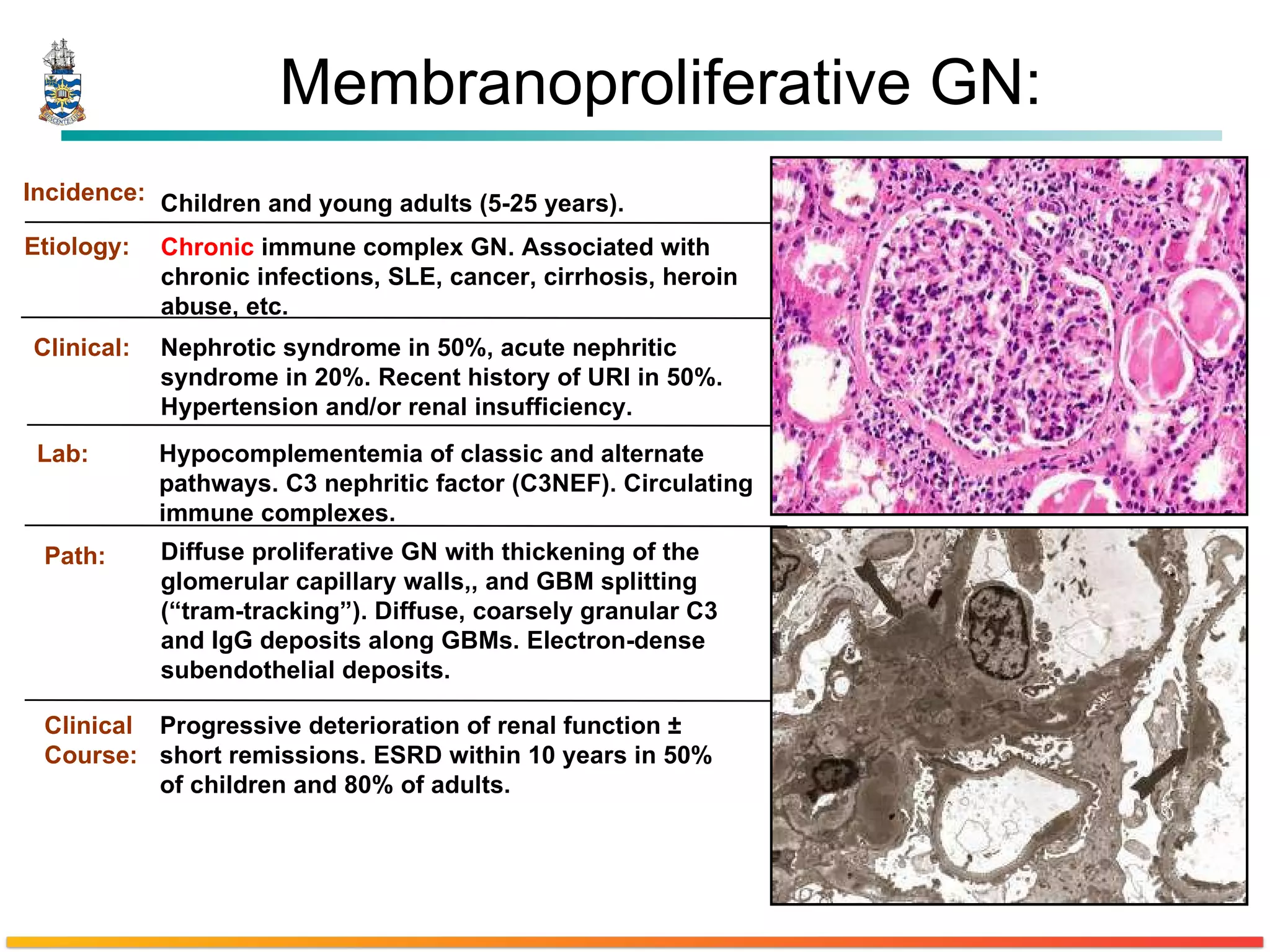 Membranoproliferative GN: Etiology: Chronic  immune complex GN. Associated with chronic infections, SLE, cancer, cirrhosis, heroin abuse, etc. Clinical: Nephrotic syndrome in 50%, acute nephritic syndrome in 20%. Recent history of URI in 50%. Hypertension and/or renal insufficiency. Lab: Hypocomplementemia of classic and alternate pathways. C3 nephritic factor (C3NEF). Circulating immune complexes. Clinical Course: Progressive deterioration of renal function ± short remissions. ESRD within 10 years in 50% of children and 80% of adults. Path: Diffuse proliferative GN with thickening of the glomerular capillary walls,, and GBM splitting (“tram-tracking”). Diffuse, coarsely granular C3 and IgG deposits along GBMs. Electron-dense subendothelial deposits. Incidence: Children and young adults (5-25 years).  
