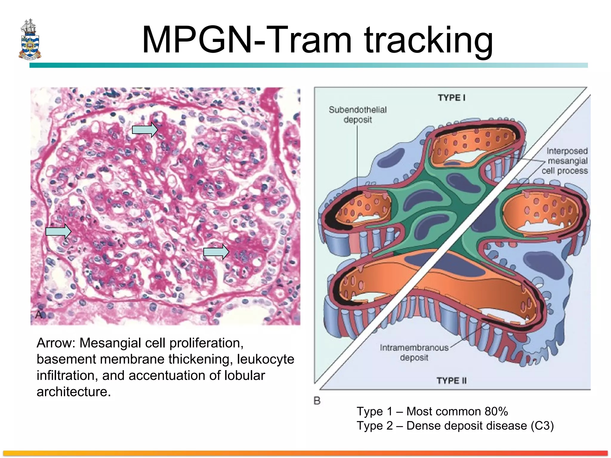 MPGN-Tram tracking Arrow: Mesangial cell proliferation, basement membrane thickening, leukocyte infiltration, and accentuation of lobular architecture.  Type 1 – Most common 80% Type 2 – Dense deposit disease (C3) 