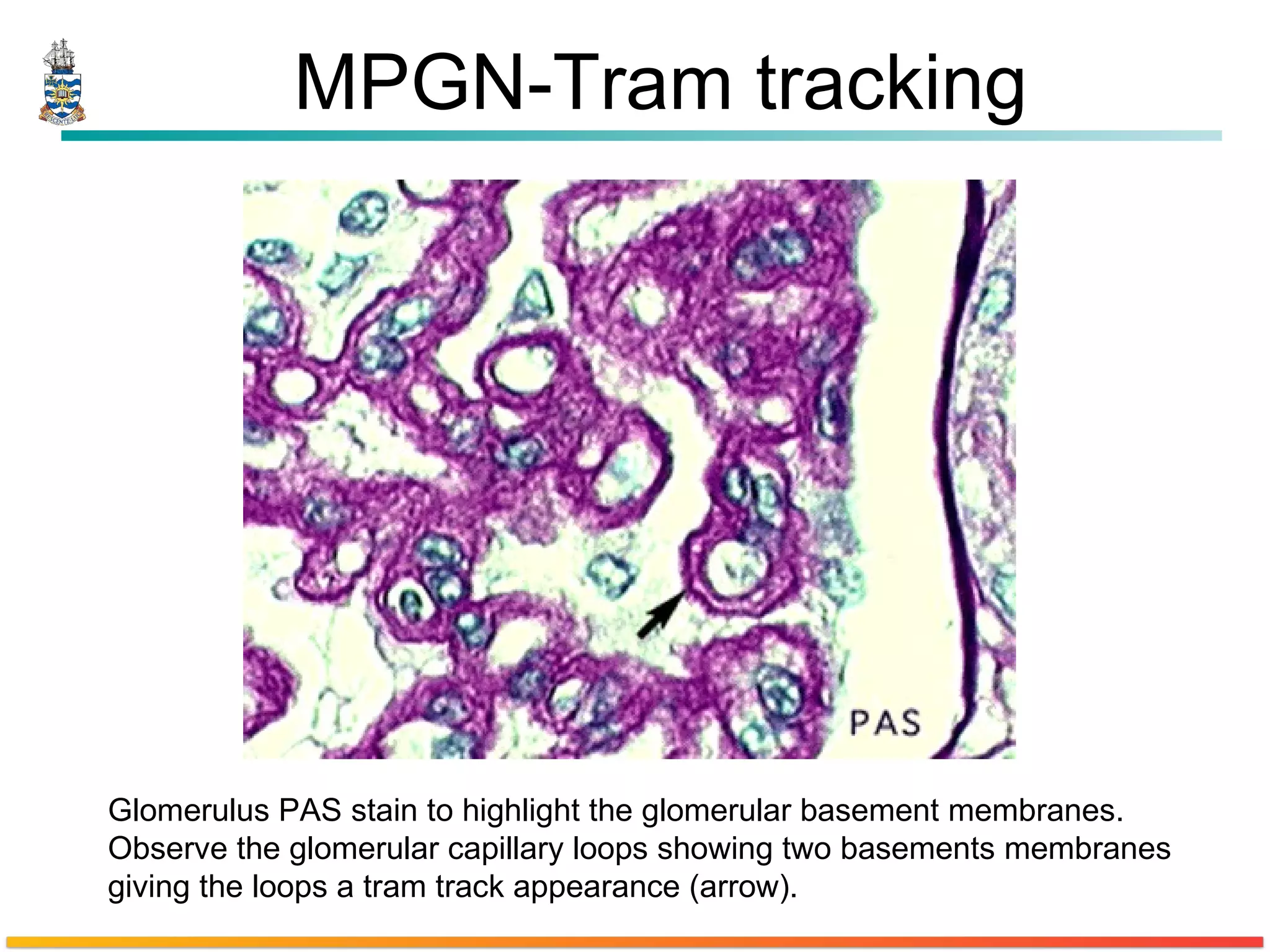 MPGN-Tram tracking Glomerulus PAS stain to highlight the glomerular basement membranes. Observe the glomerular capillary loops showing two basements membranes giving the loops a tram track appearance (arrow).  