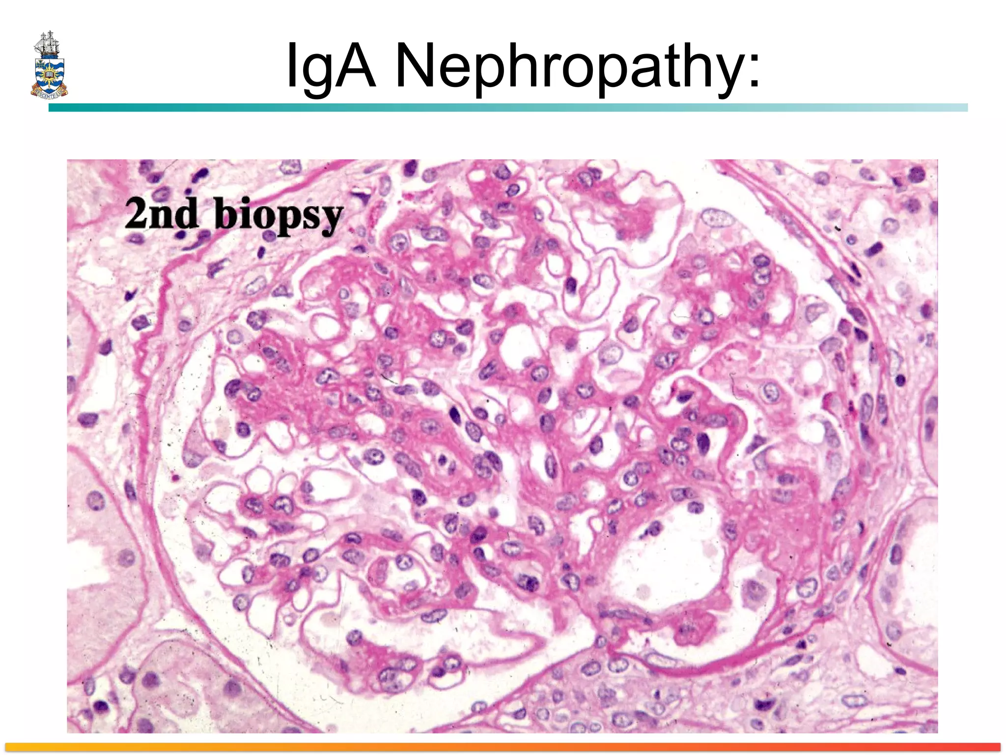 IgA Nephropathy: 
