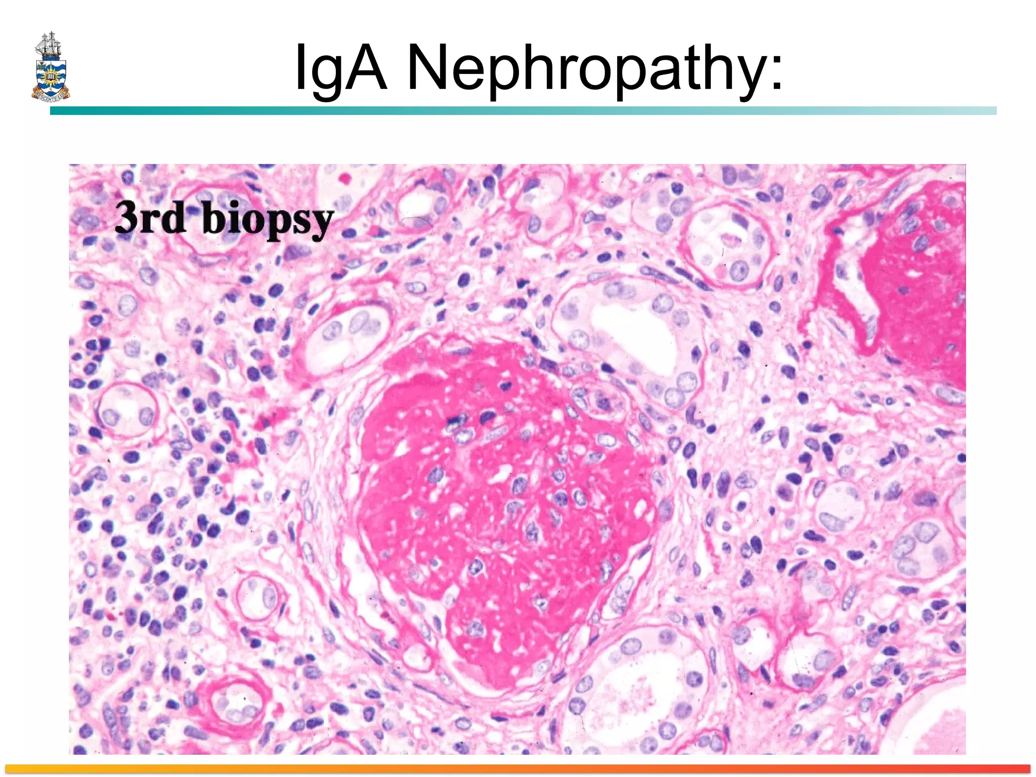 IgA Nephropathy: 