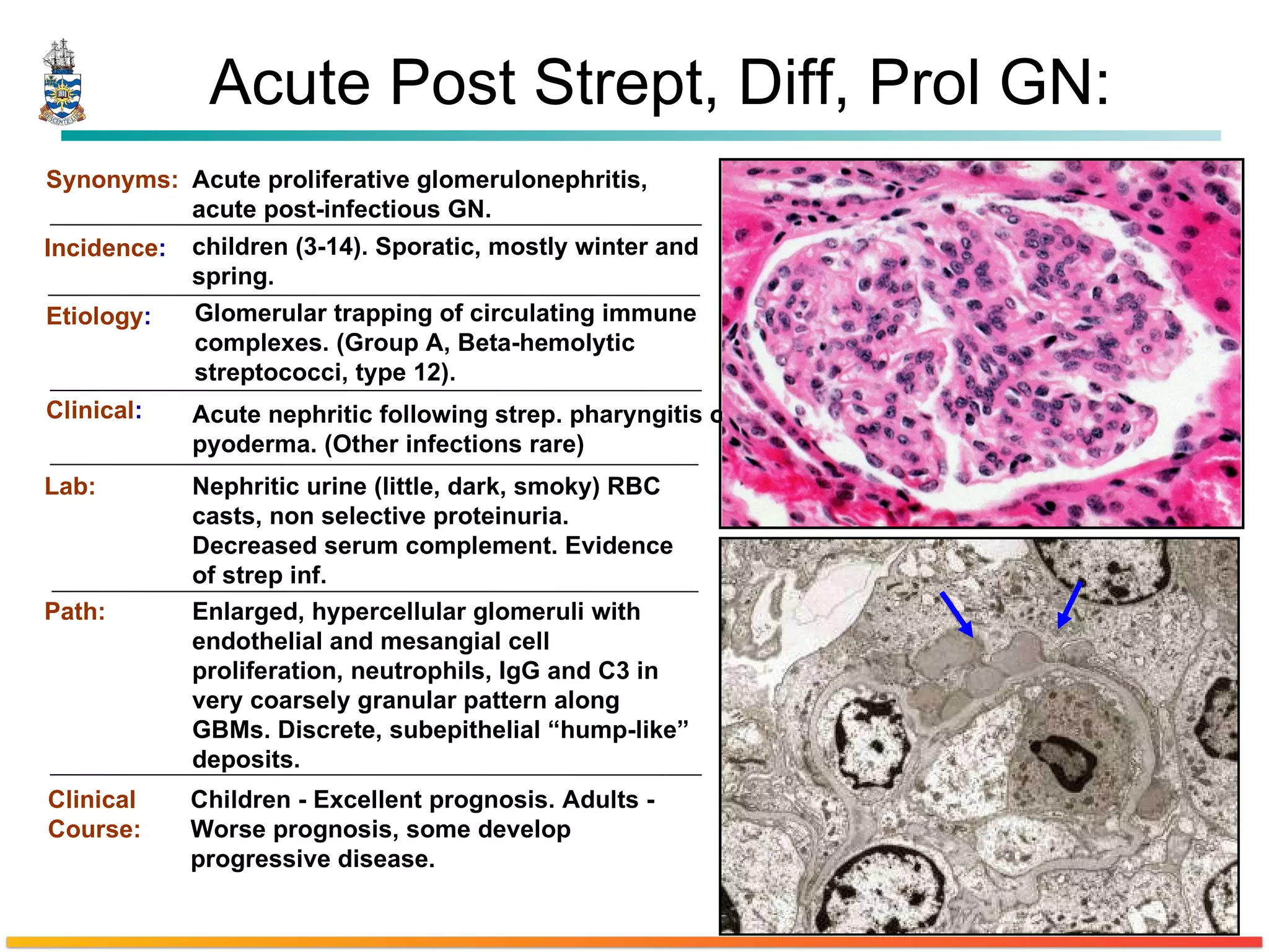 Acute Post Strept, Diff, Prol GN: Synonyms: Incidence : Etiology : Clinical : Lab: Path: Clinical Course: Acute proliferative glomerulonephritis, acute post-infectious GN. Glomerular trapping of circulating immune complexes. (Group A, Beta-hemolytic streptococci, type 12). Acute nephritic following strep. pharyngitis or pyoderma. (Other infections rare) Nephritic urine (little, dark, smoky) RBC casts, non selective proteinuria. Decreased serum complement. Evidence of strep inf. Children - Excellent prognosis. Adults - Worse prognosis, some develop progressive disease.  Enlarged, hypercellular glomeruli with endothelial and mesangial cell proliferation, neutrophils, IgG and C3 in very coarsely granular pattern along GBMs. Discrete, subepithelial “hump-like” deposits. children (3-14). Sporatic, mostly winter and spring. 
