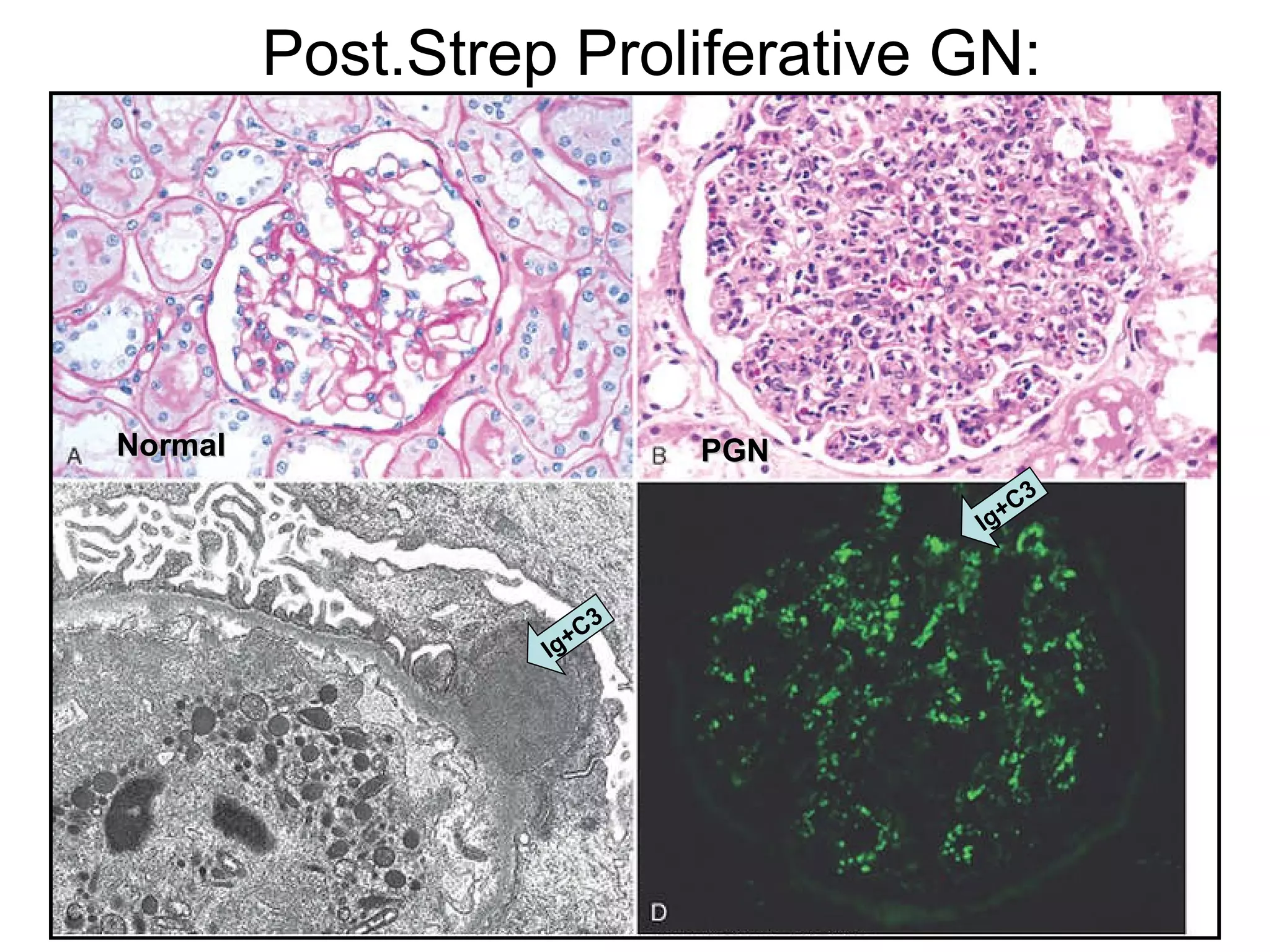 Post.Strep Proliferative GN: Normal PGN Ig+C3 Ig+C3 