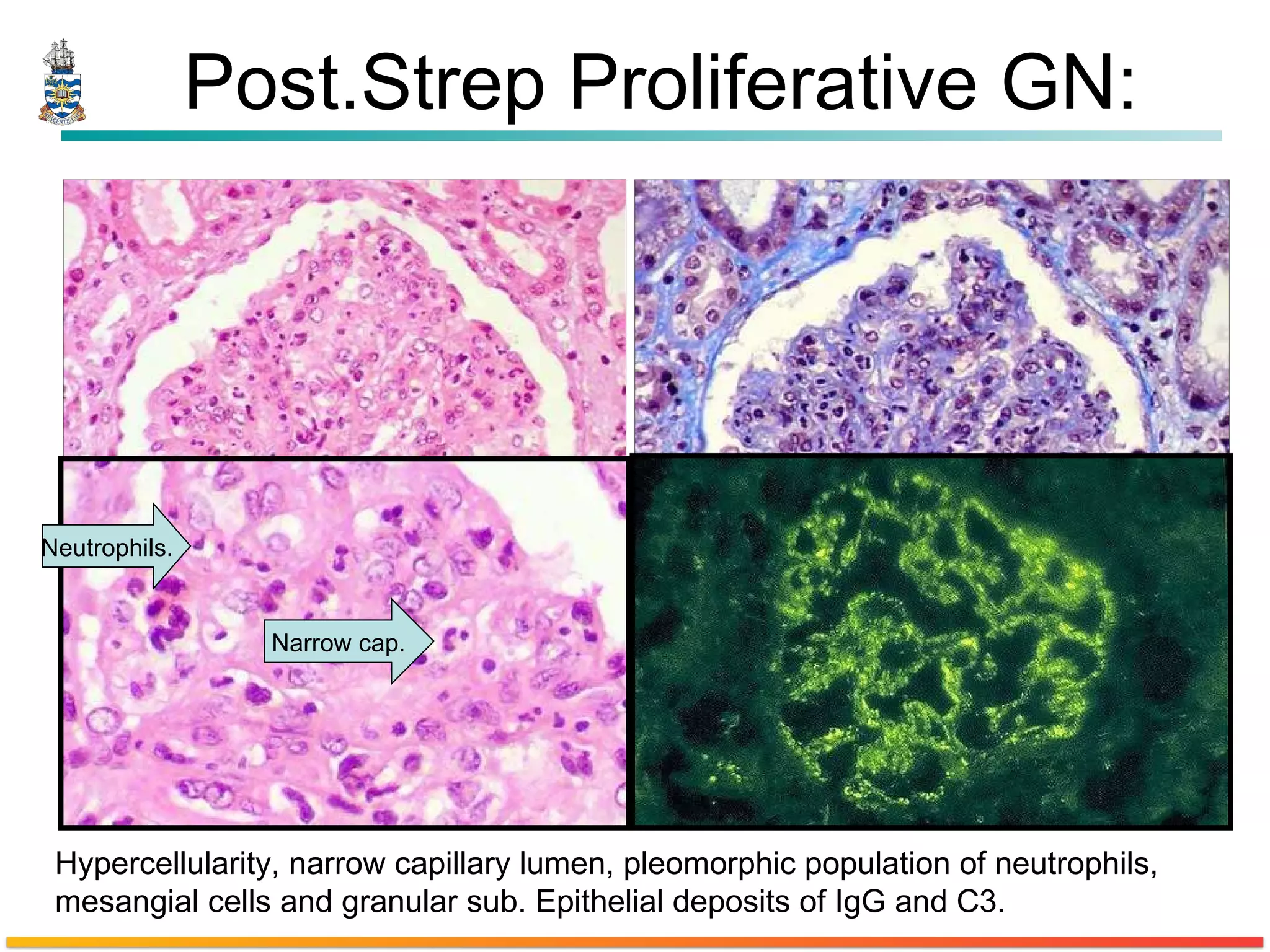 Post.Strep Proliferative GN: Hypercellularity, narrow capillary lumen, pleomorphic population of neutrophils, mesangial cells and granular sub. Epithelial deposits of IgG and C3. Neutrophils. Narrow cap. 