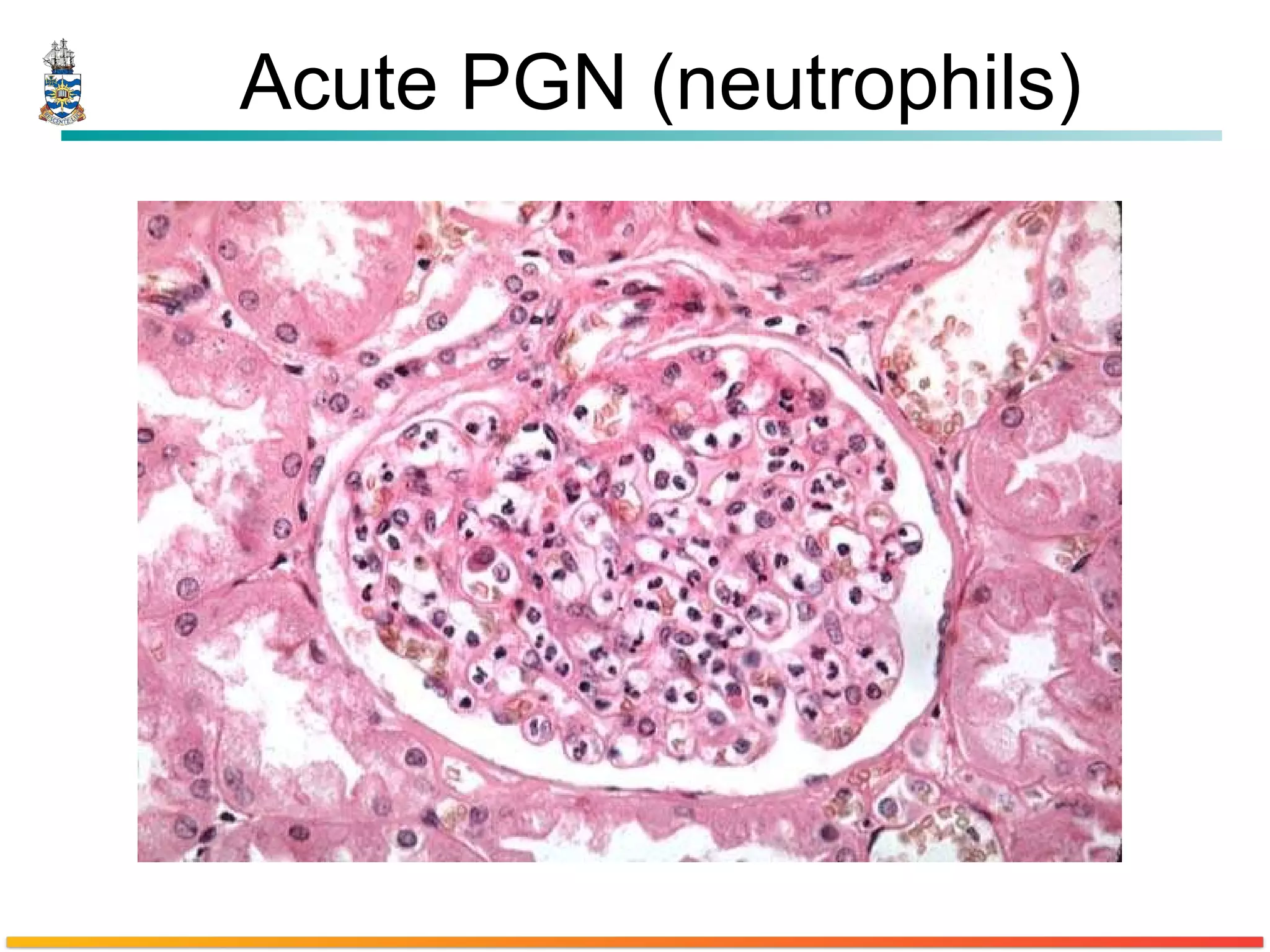 Acute PGN (neutrophils) 