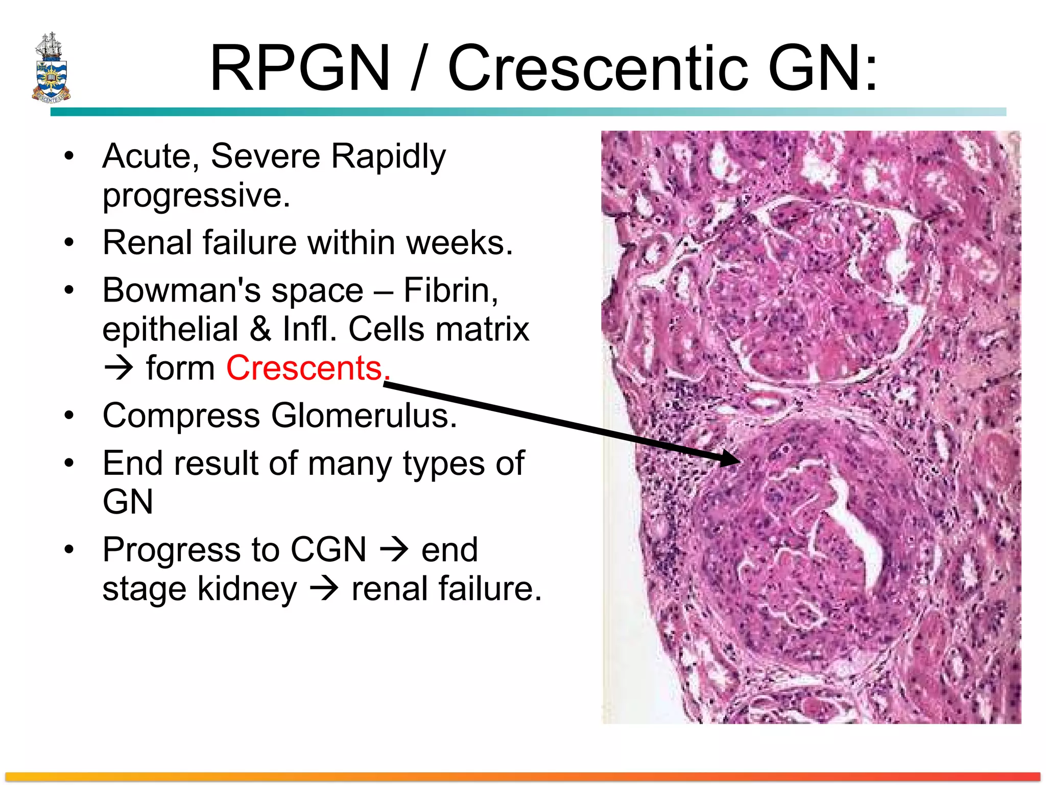 RPGN / Crescentic GN: Acute, Severe Rapidly progressive. Renal failure within weeks. Bowman's space – Fibrin, epithelial & Infl. Cells matrix    form  Crescents.   Compress Glomerulus.  End result of many types of GN  Progress to CGN    end stage kidney    renal failure. 
