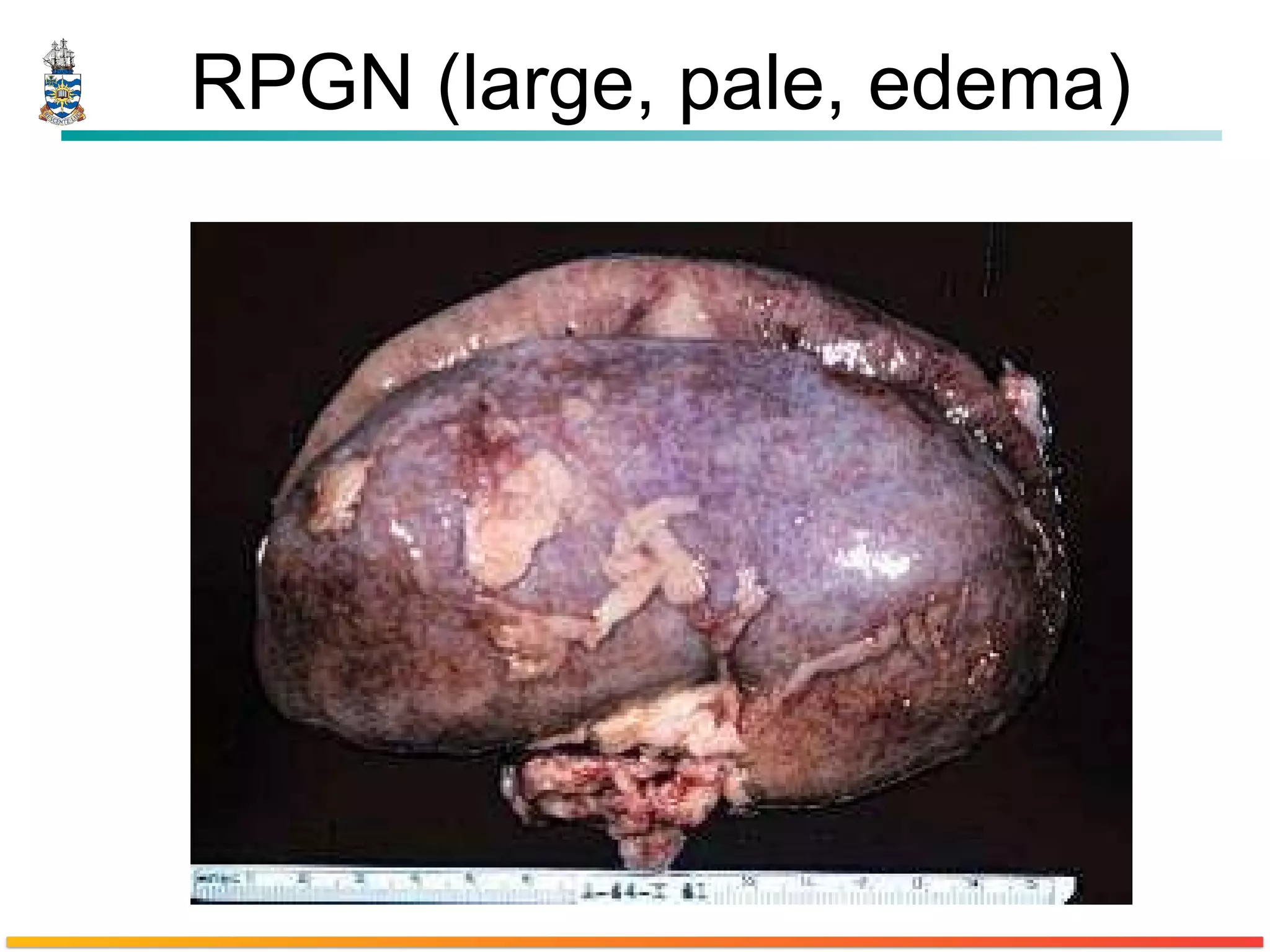 RPGN (large, pale, edema) 
