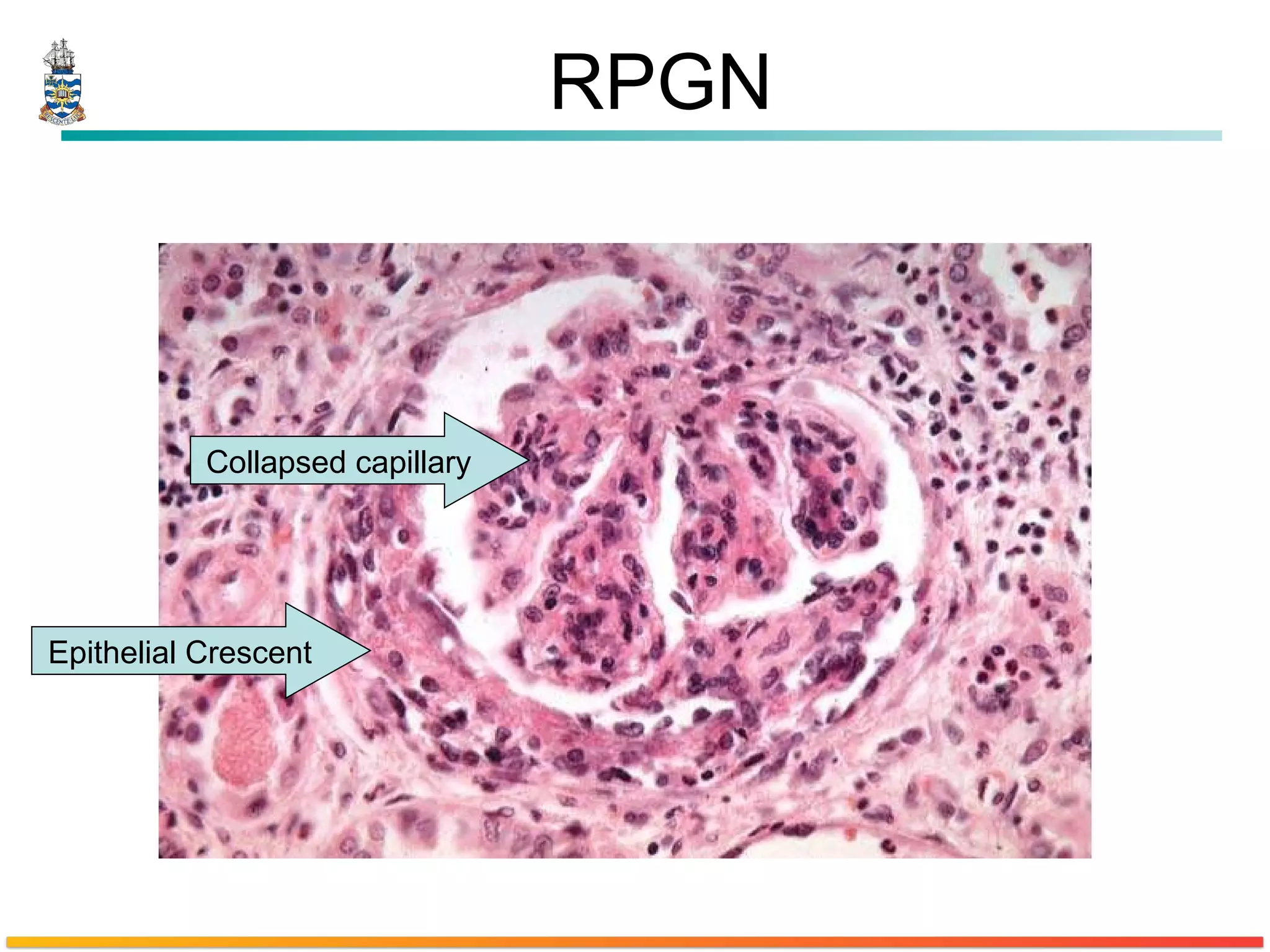 RPGN Epithelial Crescent Collapsed capillary 