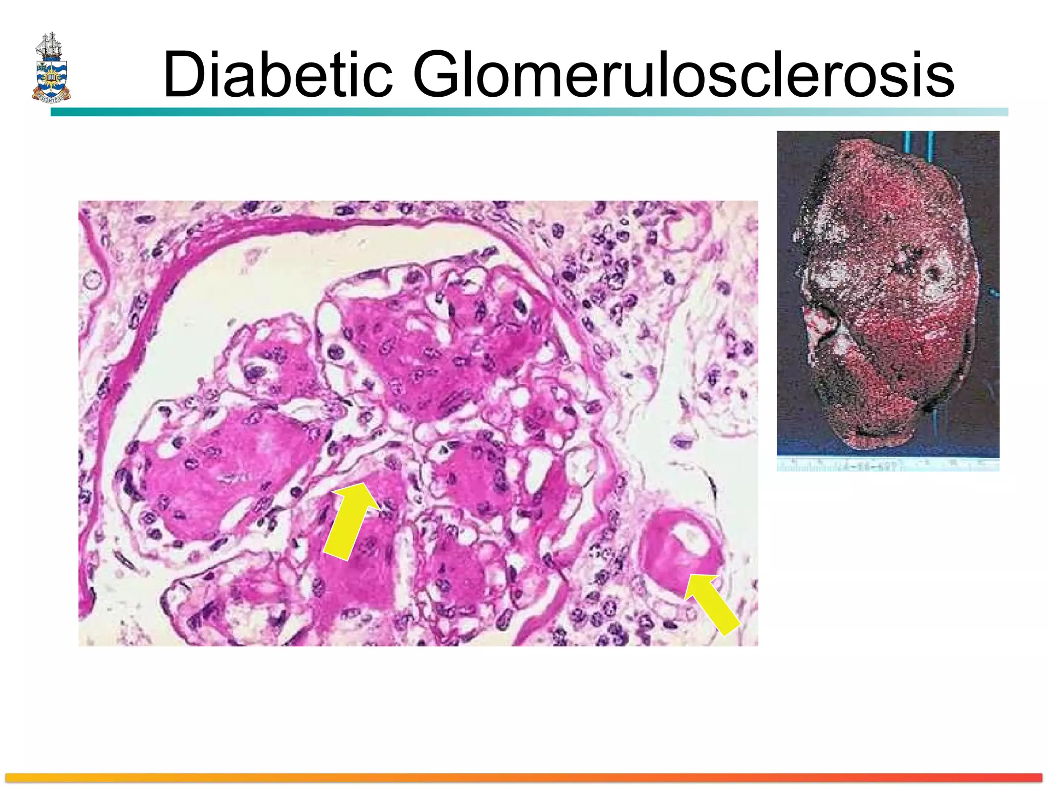 Diabetic Glomerulosclerosis 