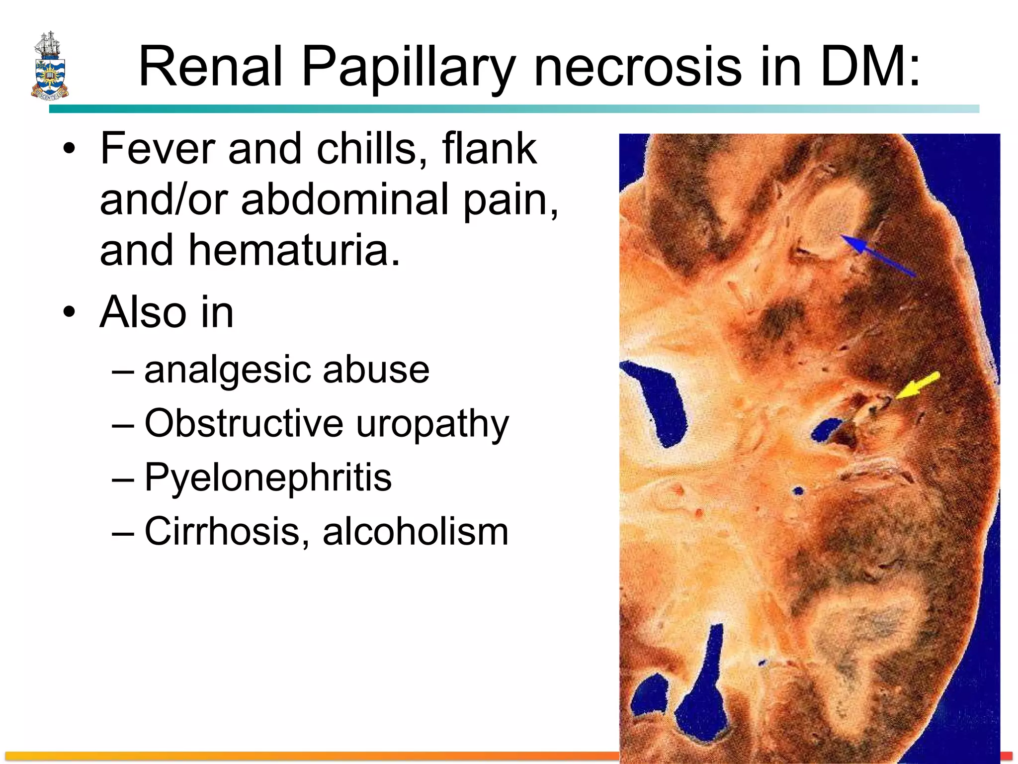 Renal Papillary necrosis in DM: Fever and chills, flank and/or abdominal pain, and hematuria. Also in  analgesic abuse Obstructive uropathy Pyelonephritis Cirrhosis, alcoholism 