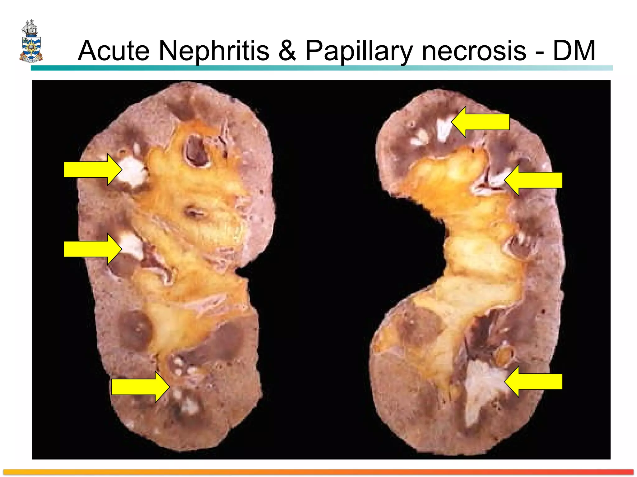 Acute Nephritis & Papillary necrosis - DM 