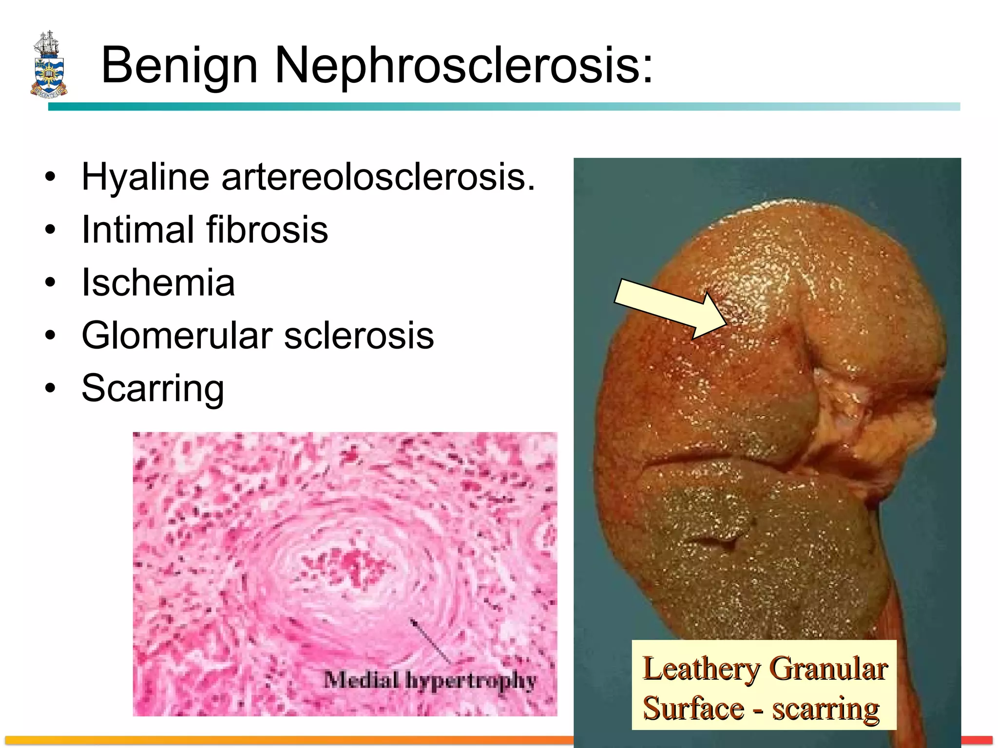 Benign Nephrosclerosis: Hyaline artereolosclerosis. Intimal fibrosis  Ischemia Glomerular sclerosis Scarring Leathery Granular Surface - scarring 