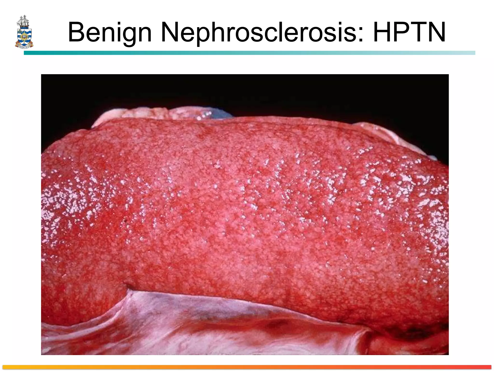Benign Nephrosclerosis: HPTN 