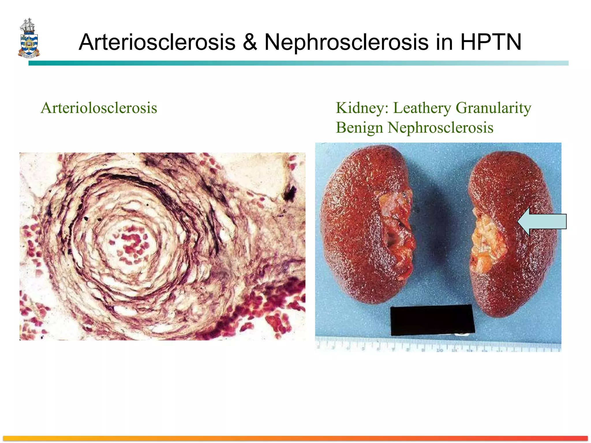 Arteriosclerosis & Nephrosclerosis in HPTN Arteriolosclerosis  Kidney: Leathery Granularity Benign Nephrosclerosis 