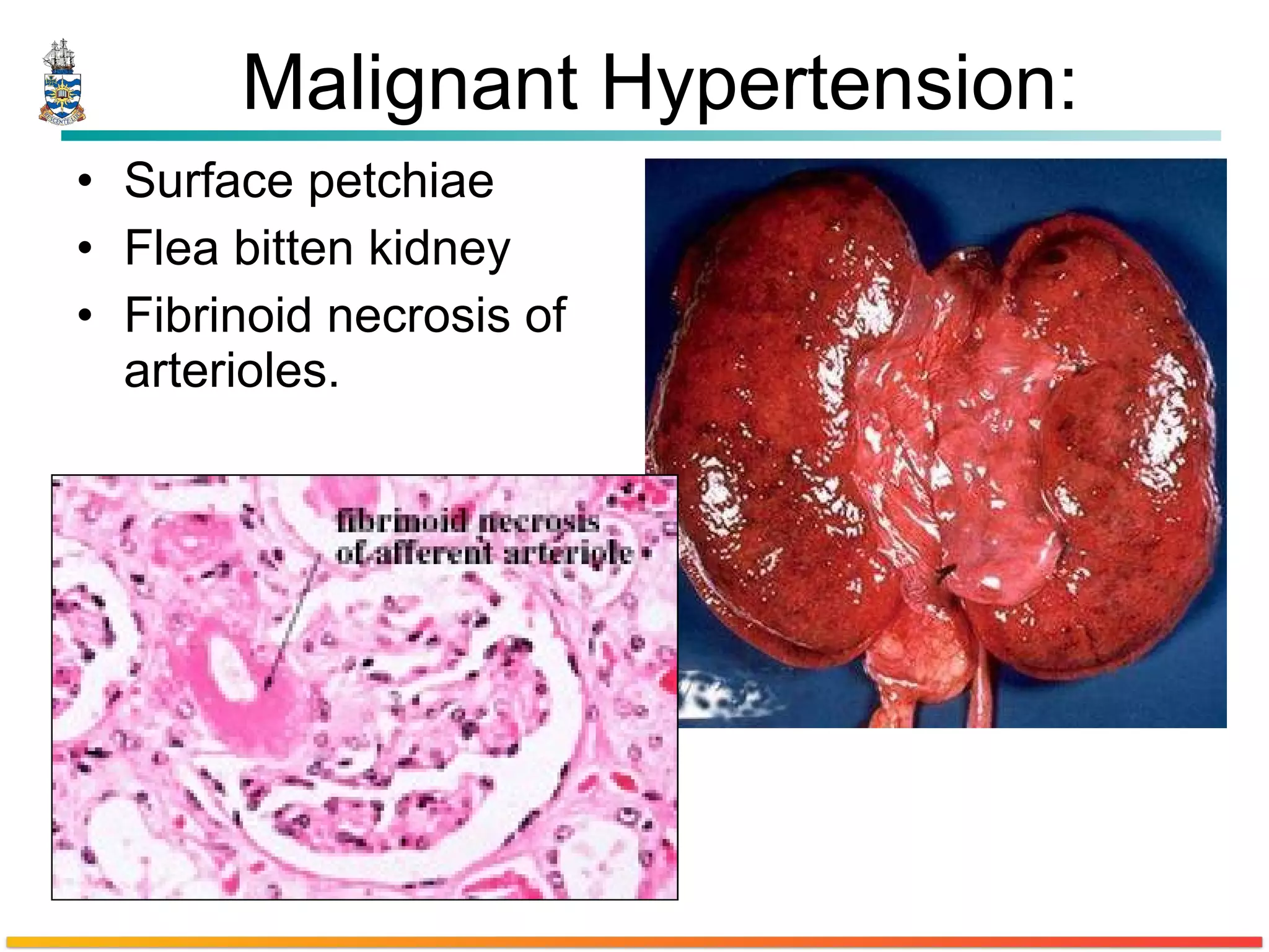 Malignant Hypertension: Surface petchiae Flea bitten kidney Fibrinoid necrosis of arterioles. 