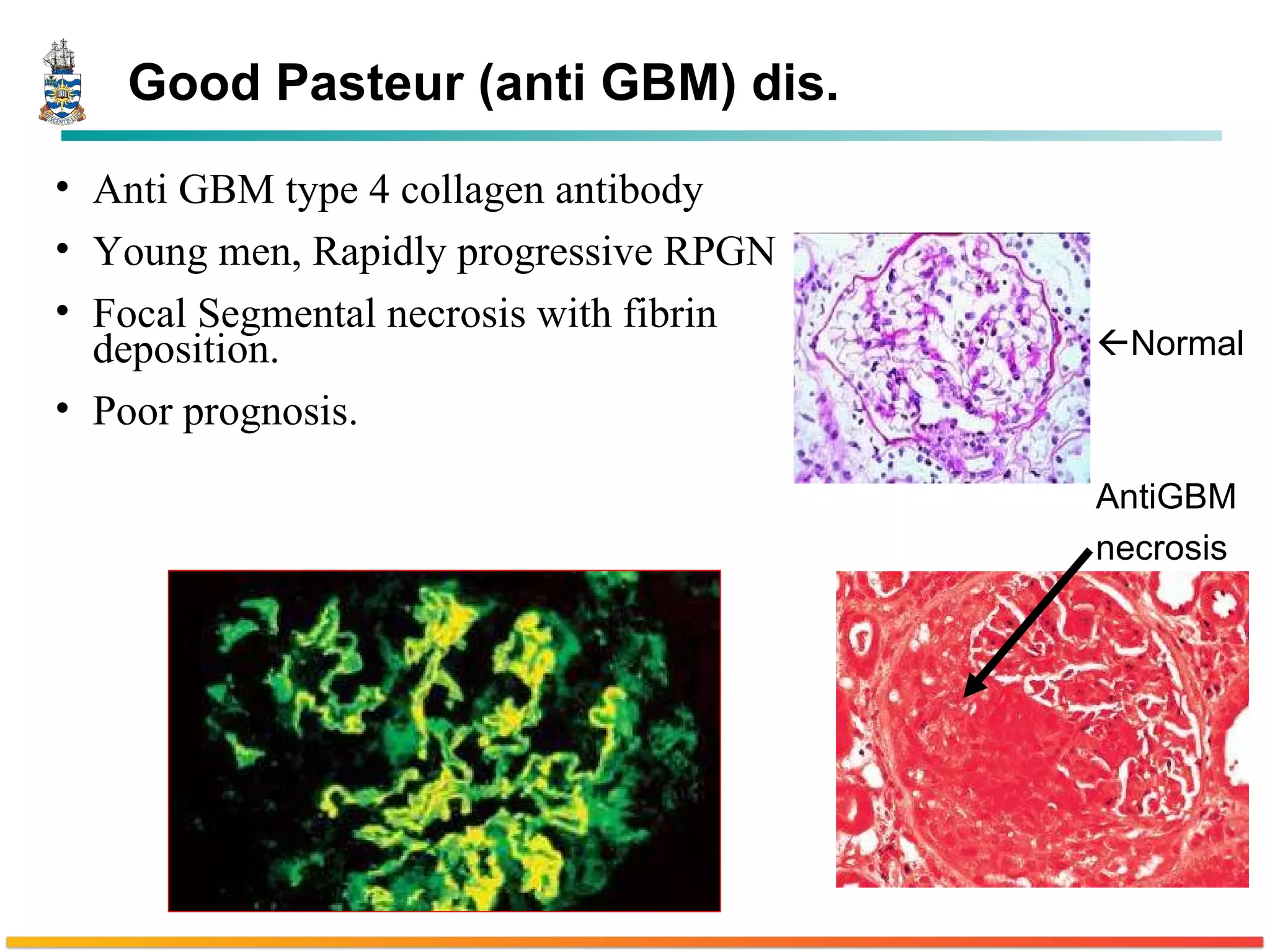 Good Pasteur (anti GBM) dis. Anti GBM type 4 collagen antibody  Young men, Rapidly progressive RPGN Focal Segmental necrosis with fibrin deposition. Poor prognosis.  Normal AntiGBM  necrosis 