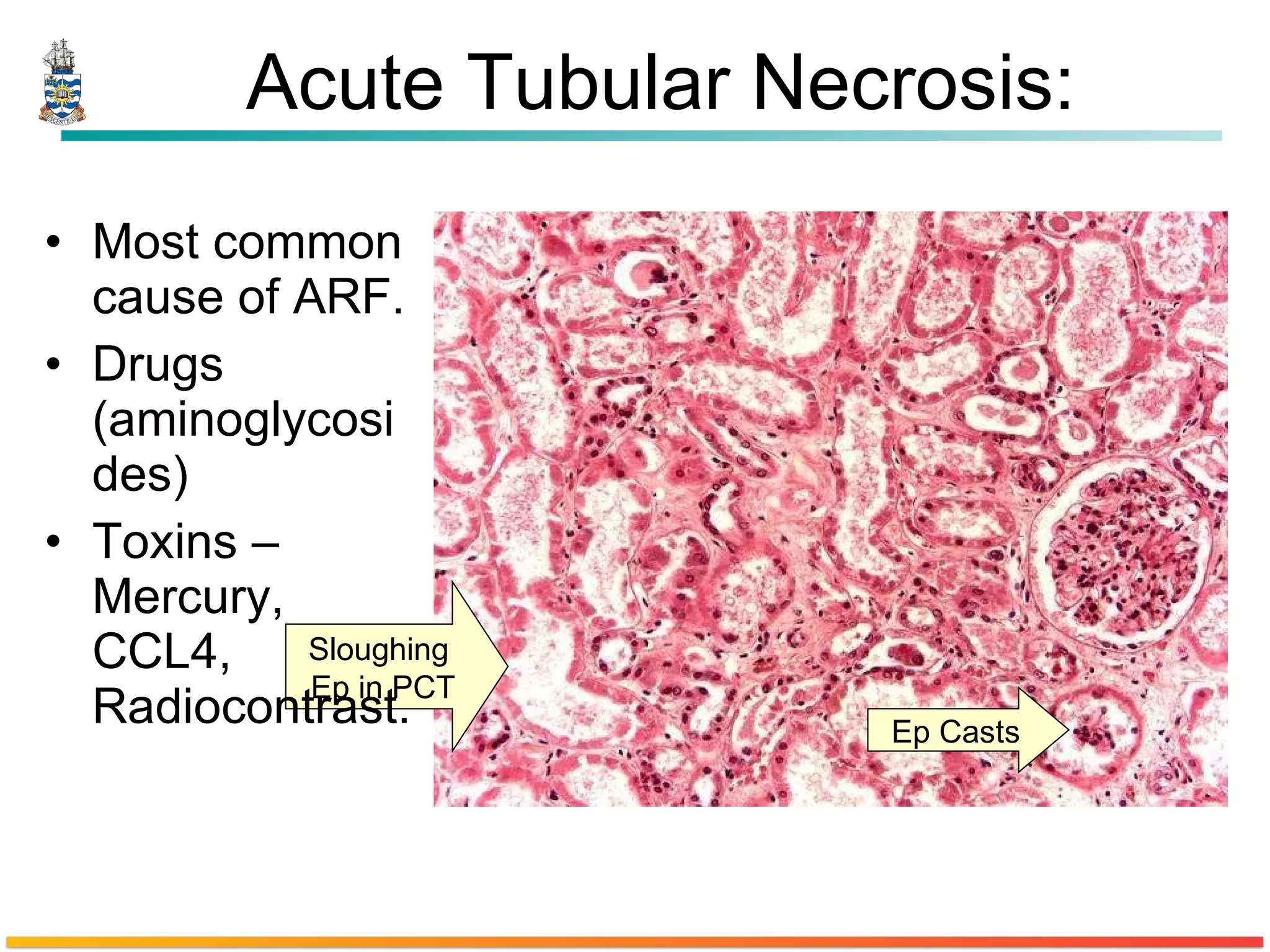 Acute Tubular Necrosis: Most common cause of ARF. Drugs (aminoglycosides) Toxins – Mercury, CCL4, Radiocontrast. Sloughing  Ep in PCT Ep Casts 