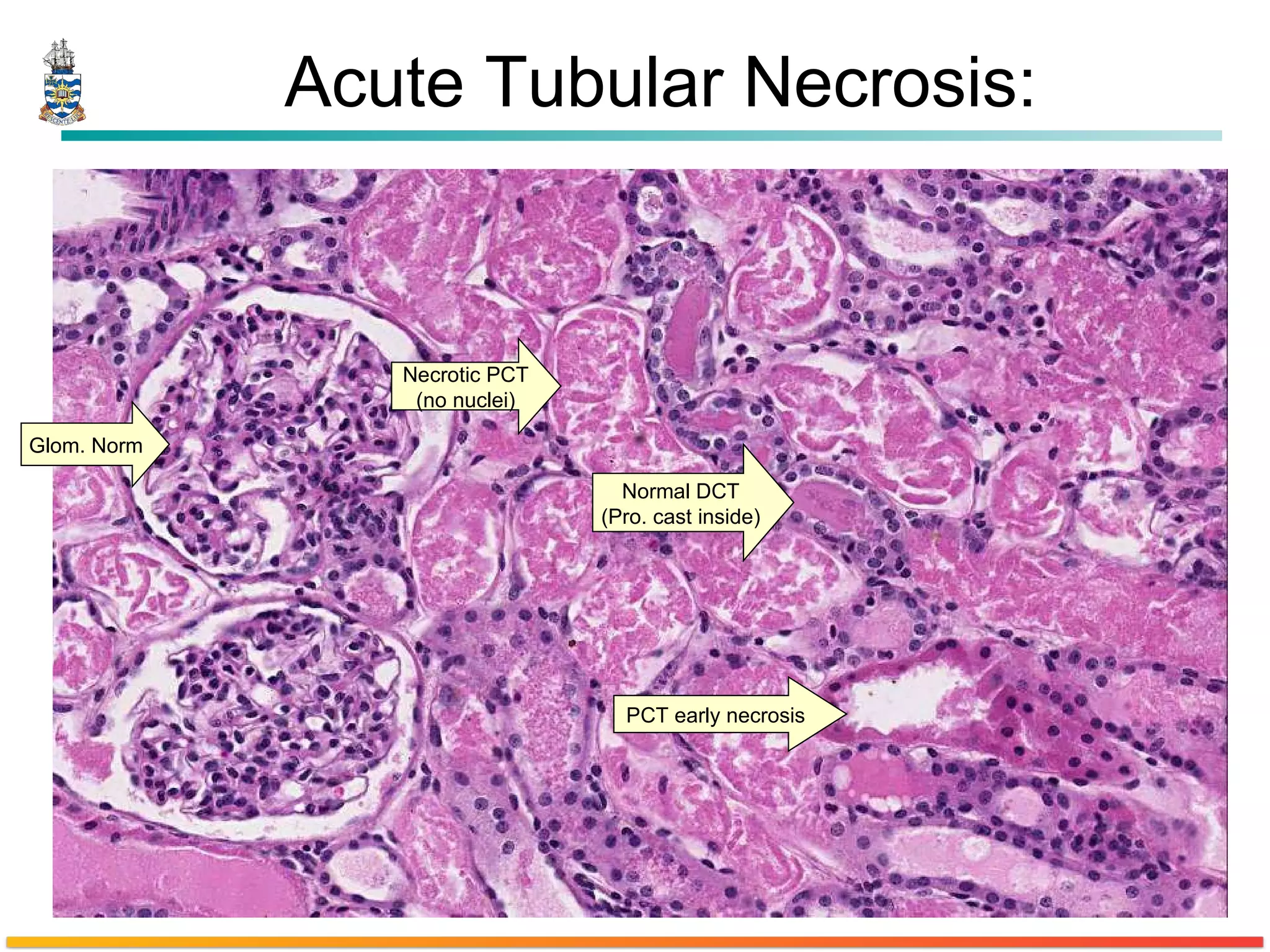 Acute Tubular Necrosis: Glom. Norm Necrotic PCT (no nuclei) Normal DCT (Pro. cast inside) PCT early necrosis 