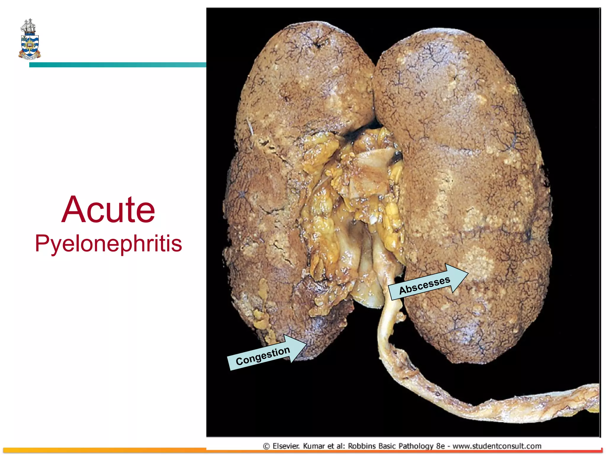 Acute  Pyelonephritis Abscesses Congestion 