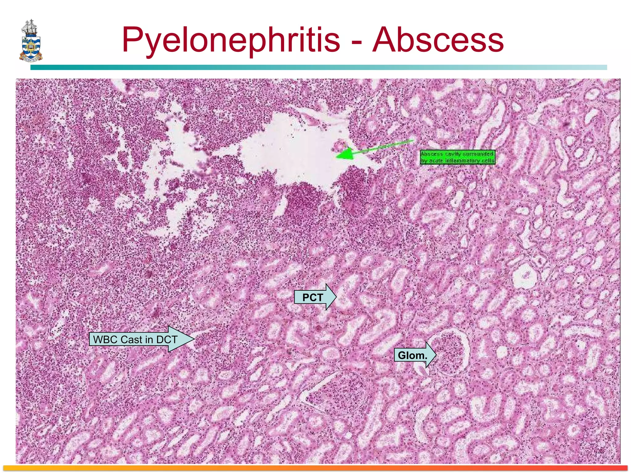 Pyelonephritis - Abscess WBC Cast in DCT PCT Glom. 