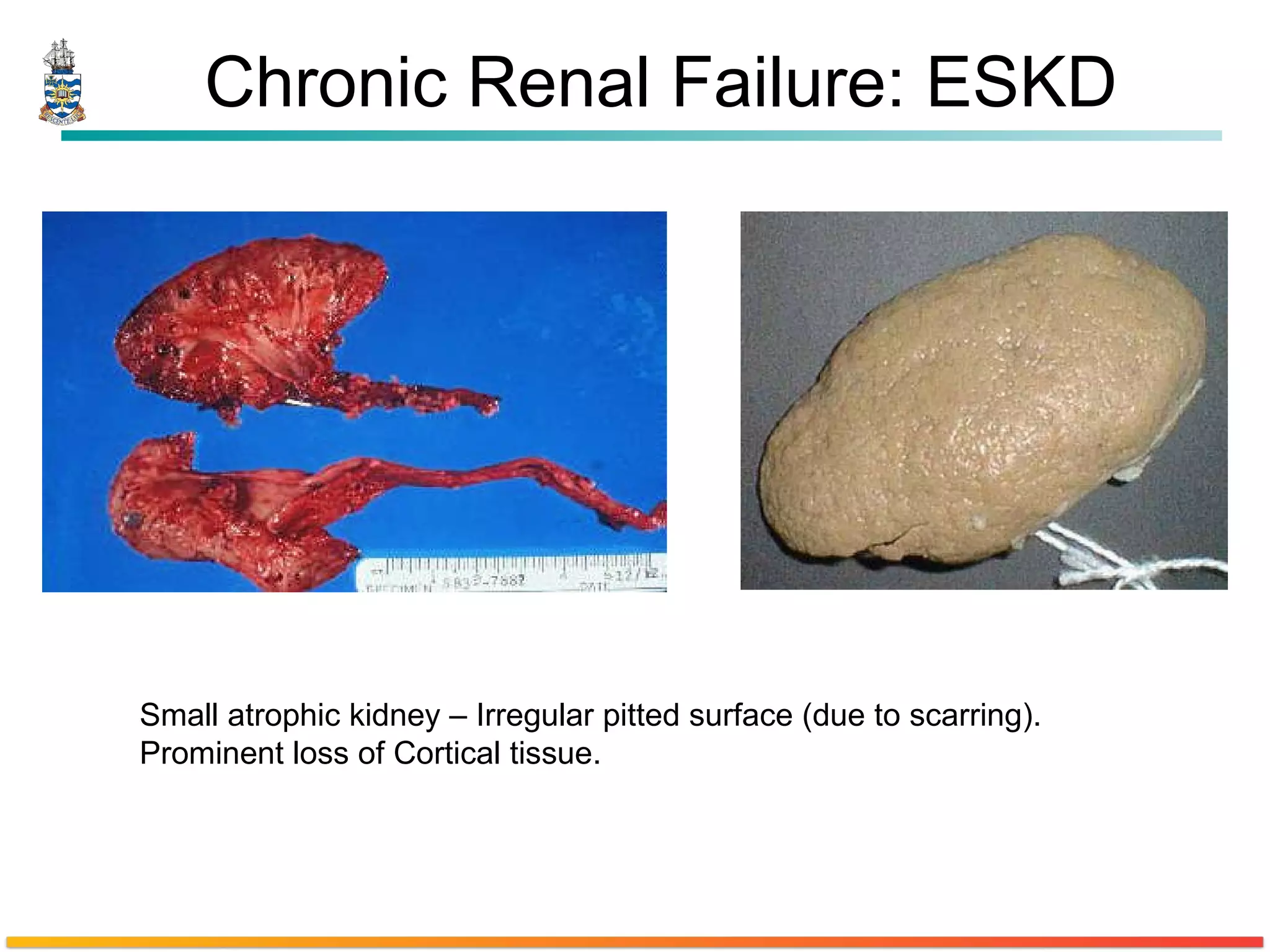 Chronic Renal Failure: ESKD Small atrophic kidney – Irregular pitted surface (due to scarring).  Prominent loss of Cortical tissue. 
