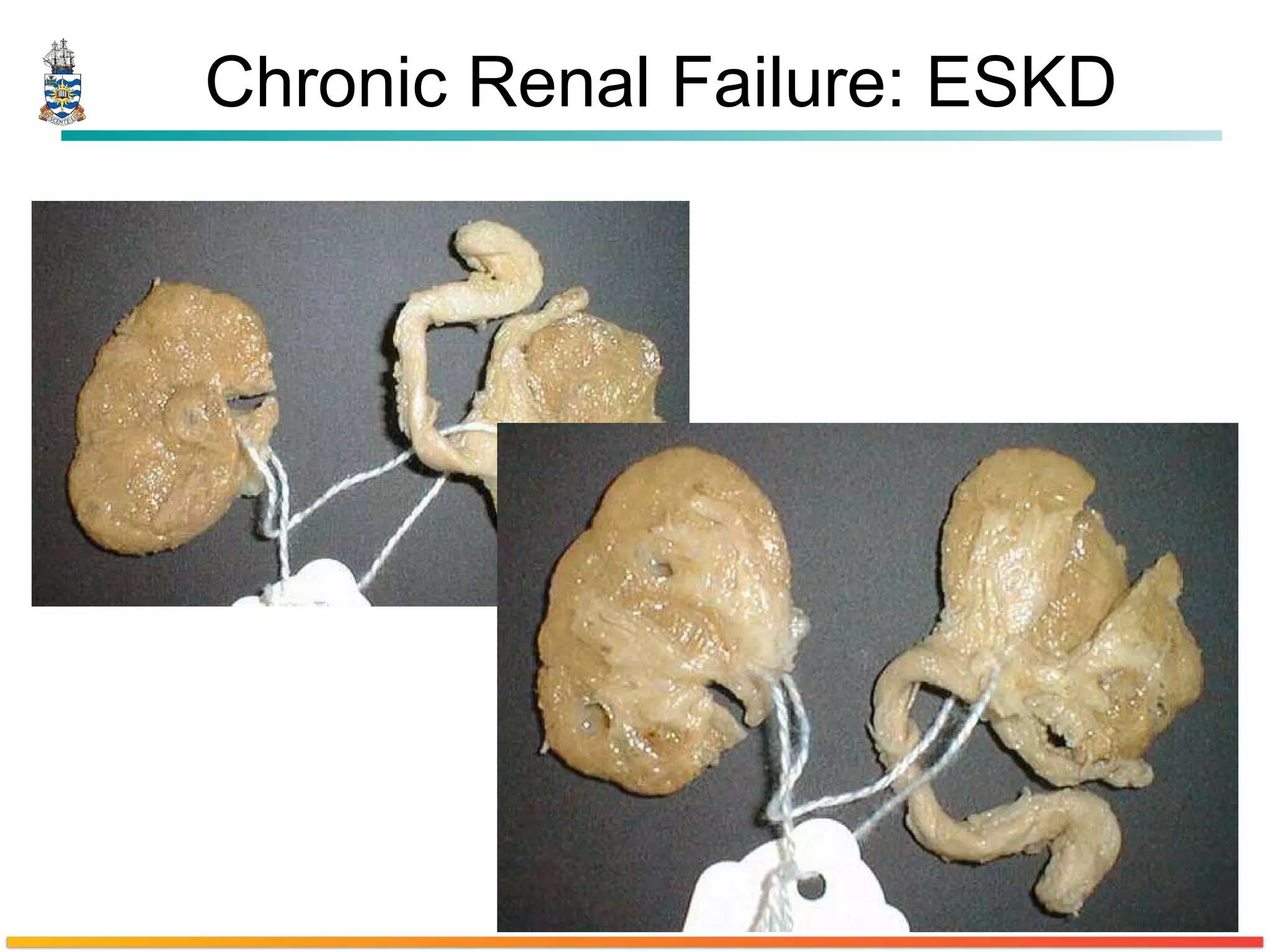 Chronic Renal Failure: ESKD 