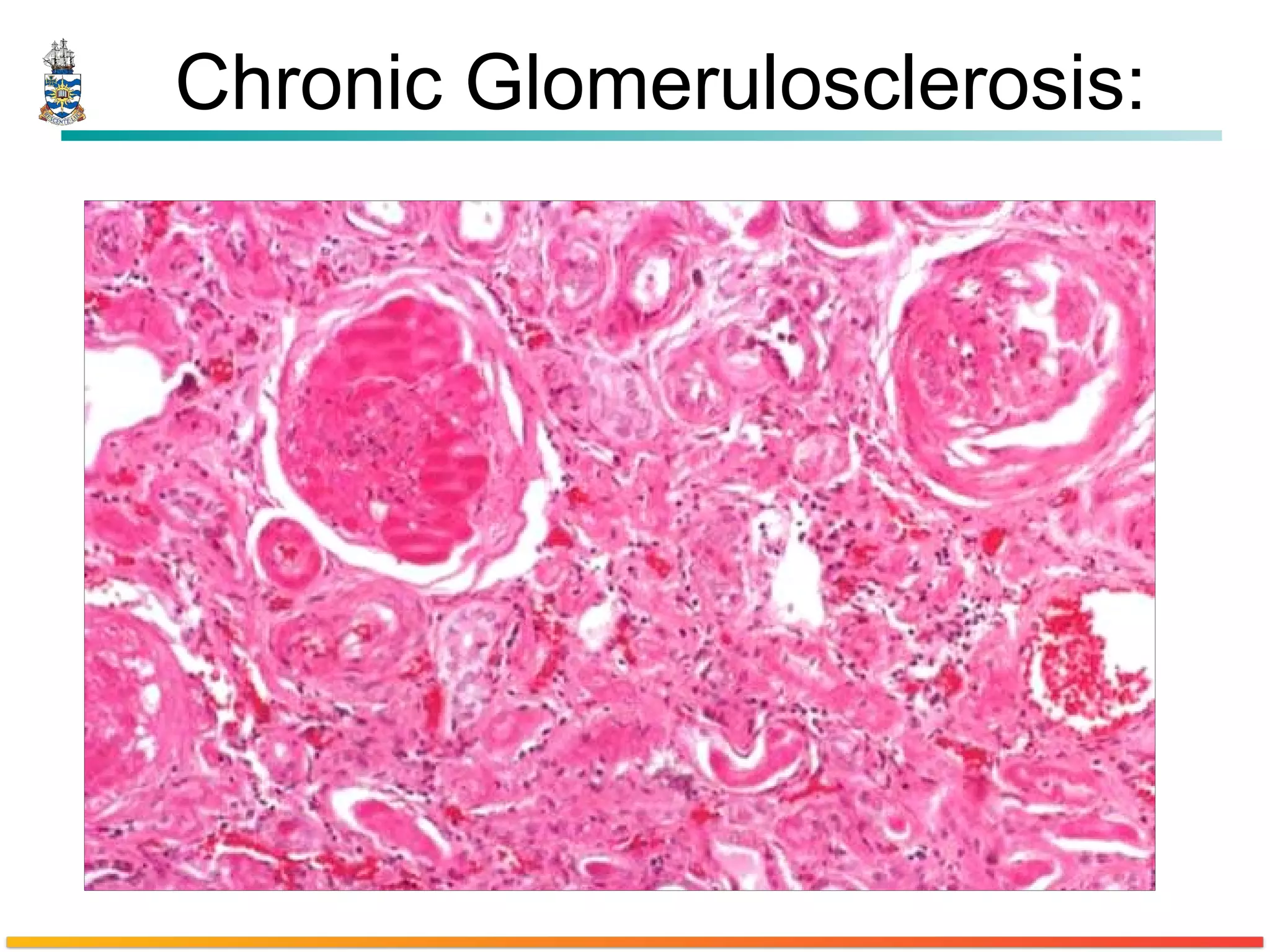 Chronic Glomerulosclerosis : 
