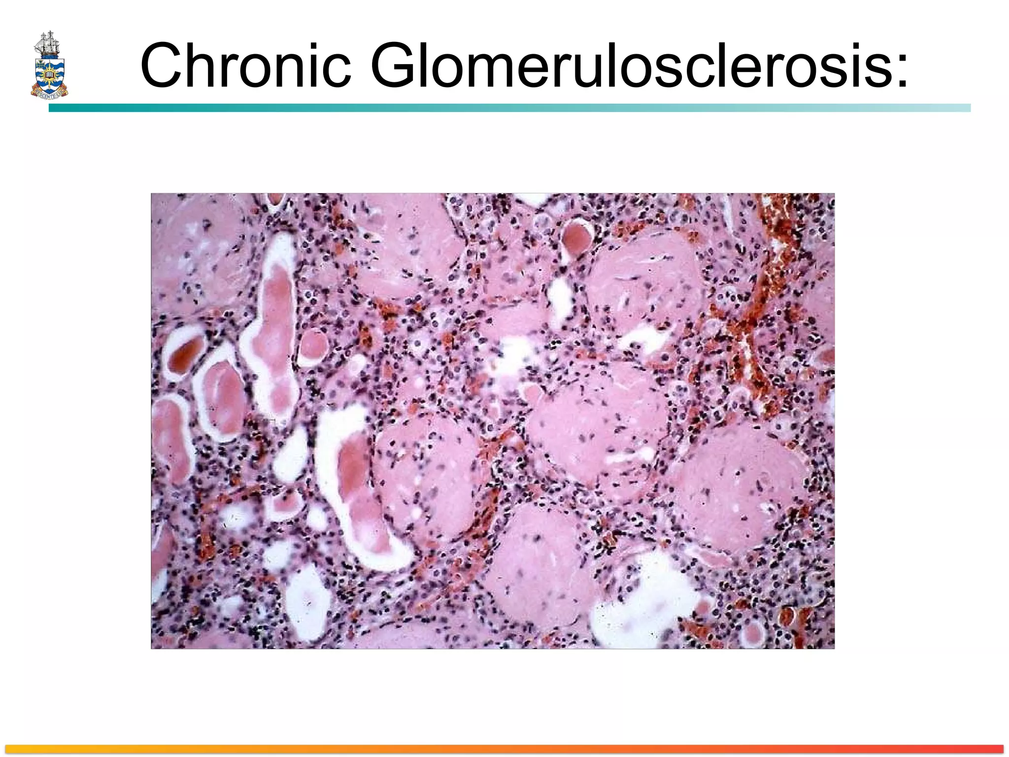 Chronic Glomerulosclerosis : 