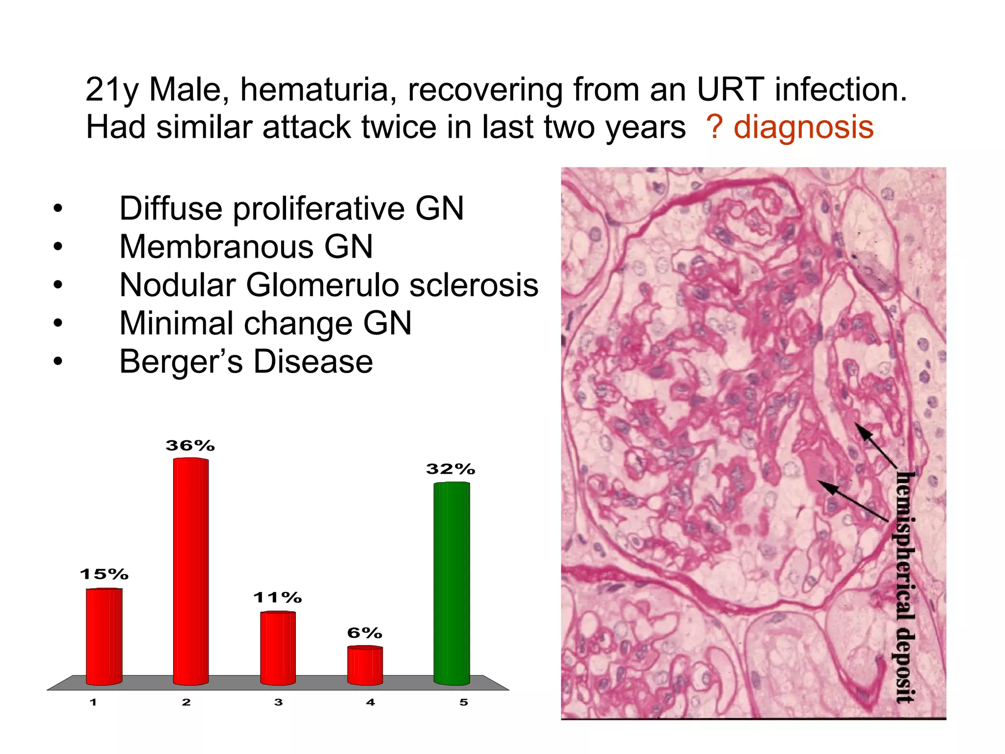 21y Male, hematuria, recovering from an URT infection. Had similar attack twice in last two years  ? diagnosis Diffuse proliferative GN Membranous GN Nodular Glomerulo sclerosis Minimal change GN Berger’s Disease 