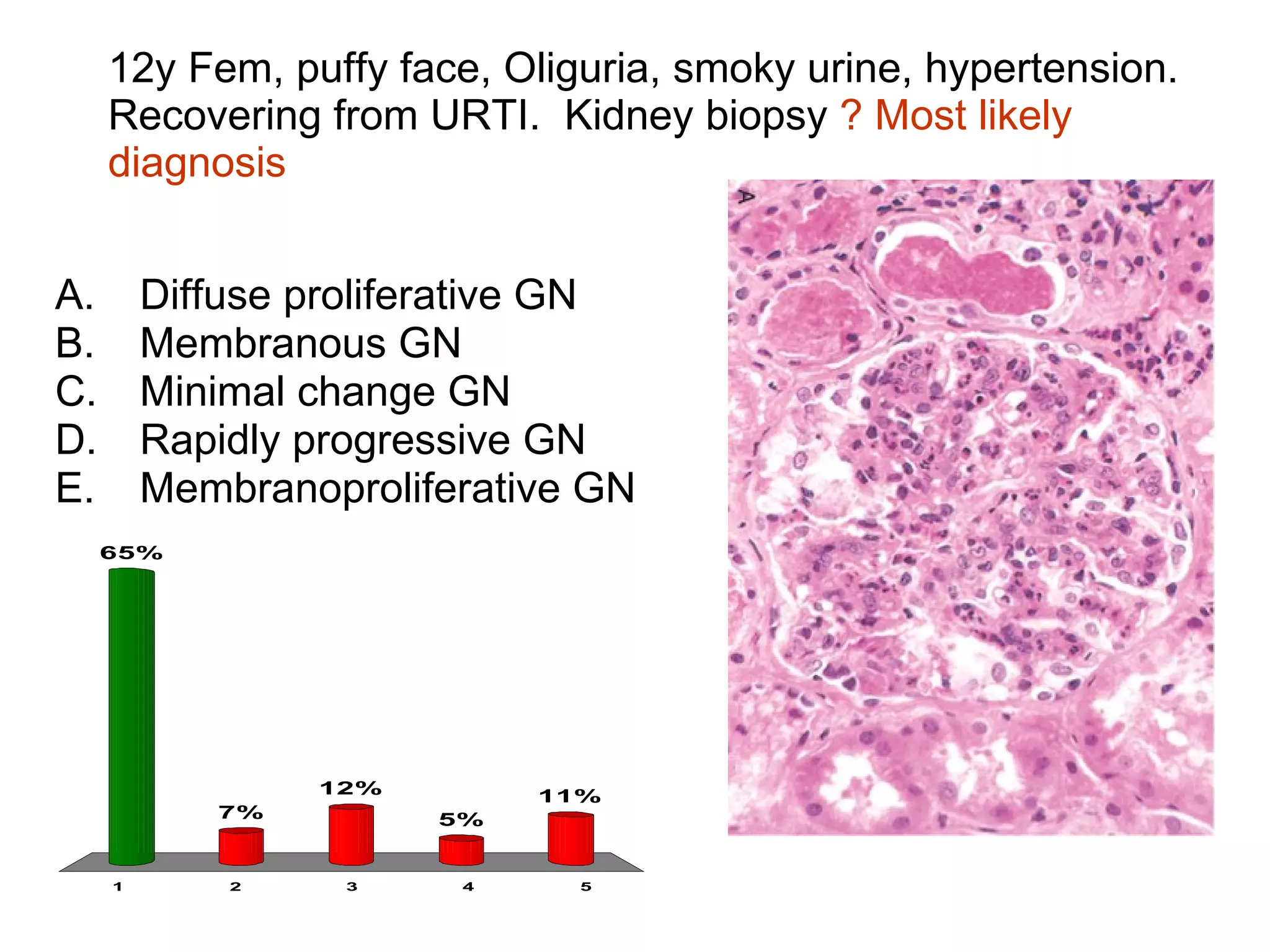 12y Fem, puffy face, Oliguria, smoky urine, hypertension. Recovering from URTI.  Kidney biopsy  ? Most likely diagnosis Diffuse proliferative GN Membranous GN Minimal change GN Rapidly progressive GN Membranoproliferative GN 