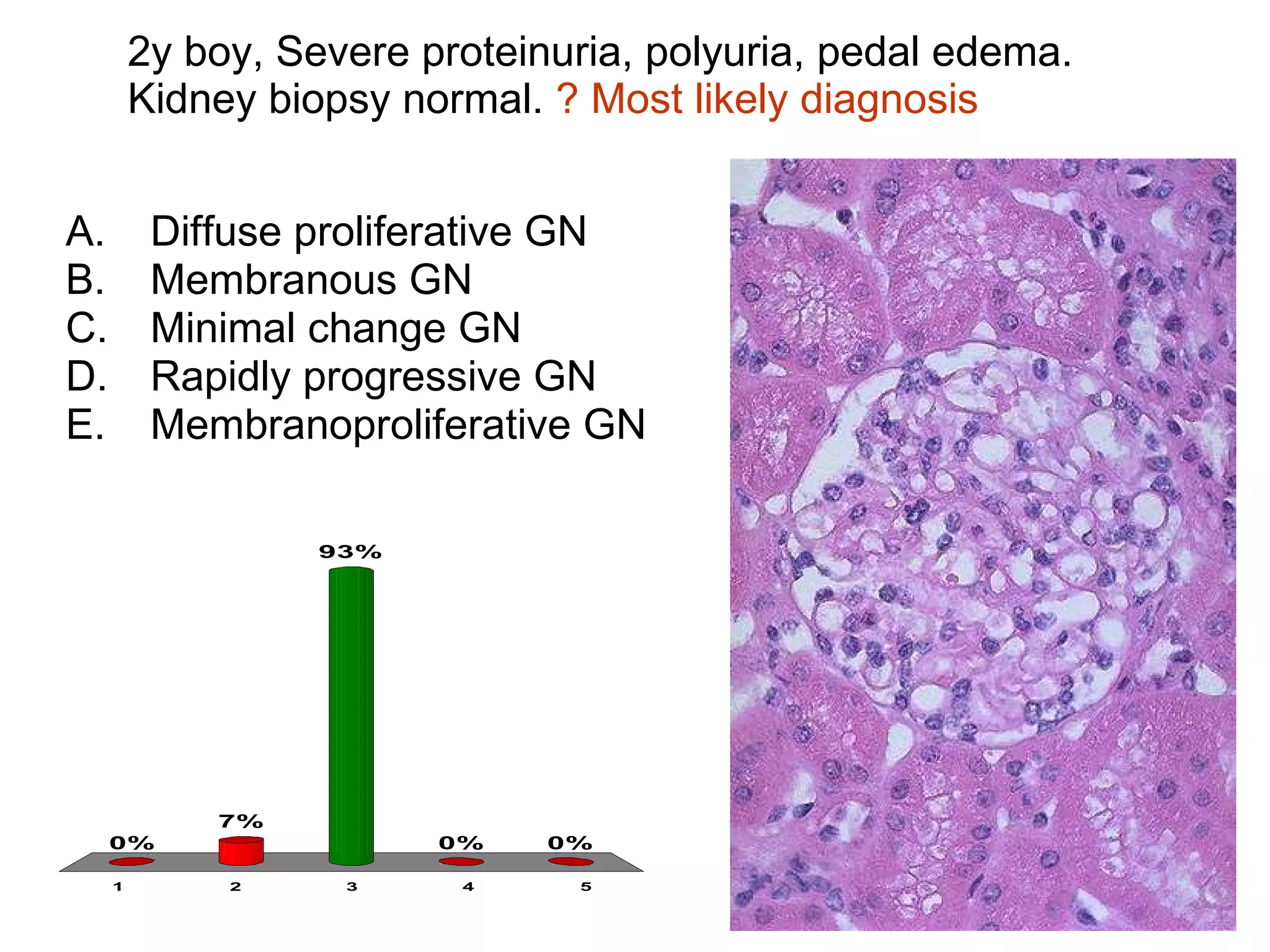 2y boy, Severe proteinuria, polyuria, pedal edema. Kidney biopsy normal.  ? Most likely diagnosis Diffuse proliferative GN Membranous GN Minimal change GN Rapidly progressive GN Membranoproliferative GN 
