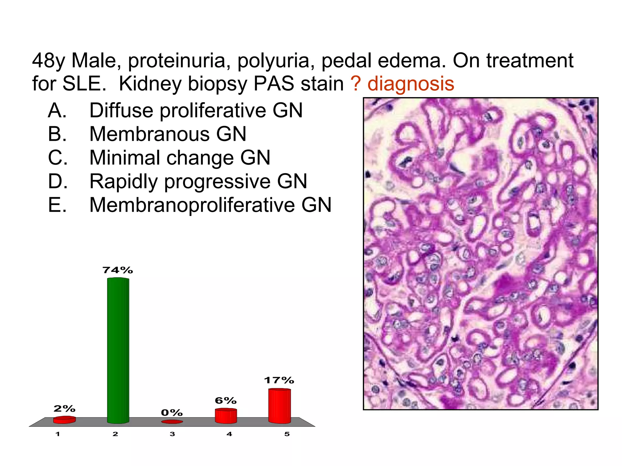 48y Male, proteinuria, polyuria, pedal edema. On treatment for SLE.  Kidney biopsy PAS stain  ? diagnosis Diffuse proliferative GN Membranous GN Minimal change GN Rapidly progressive GN Membranoproliferative GN 