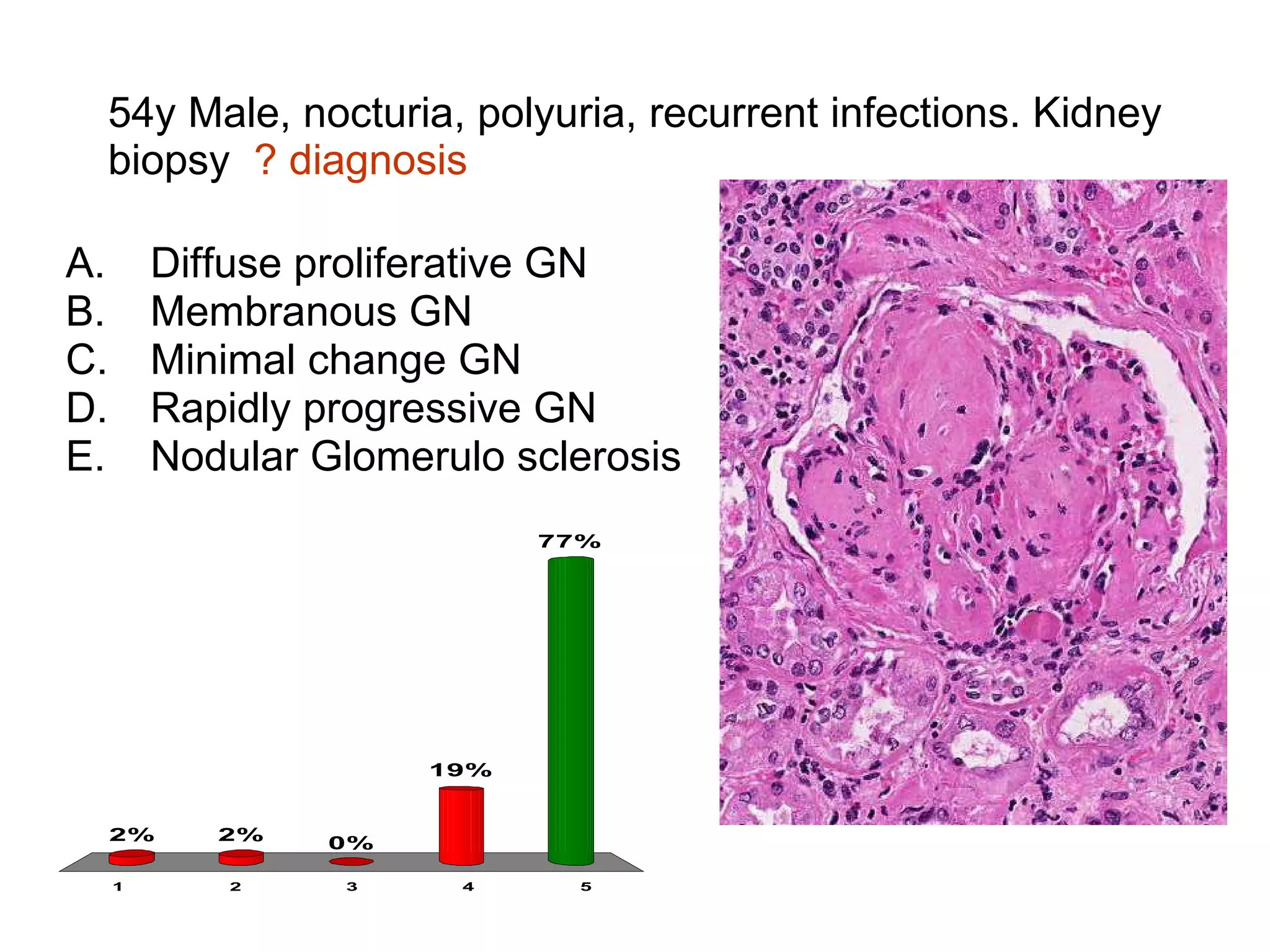 54y Male, nocturia, polyuria, recurrent infections. Kidney biopsy  ? diagnosis Diffuse proliferative GN Membranous GN Minimal change GN Rapidly progressive GN Nodular Glomerulo sclerosis 