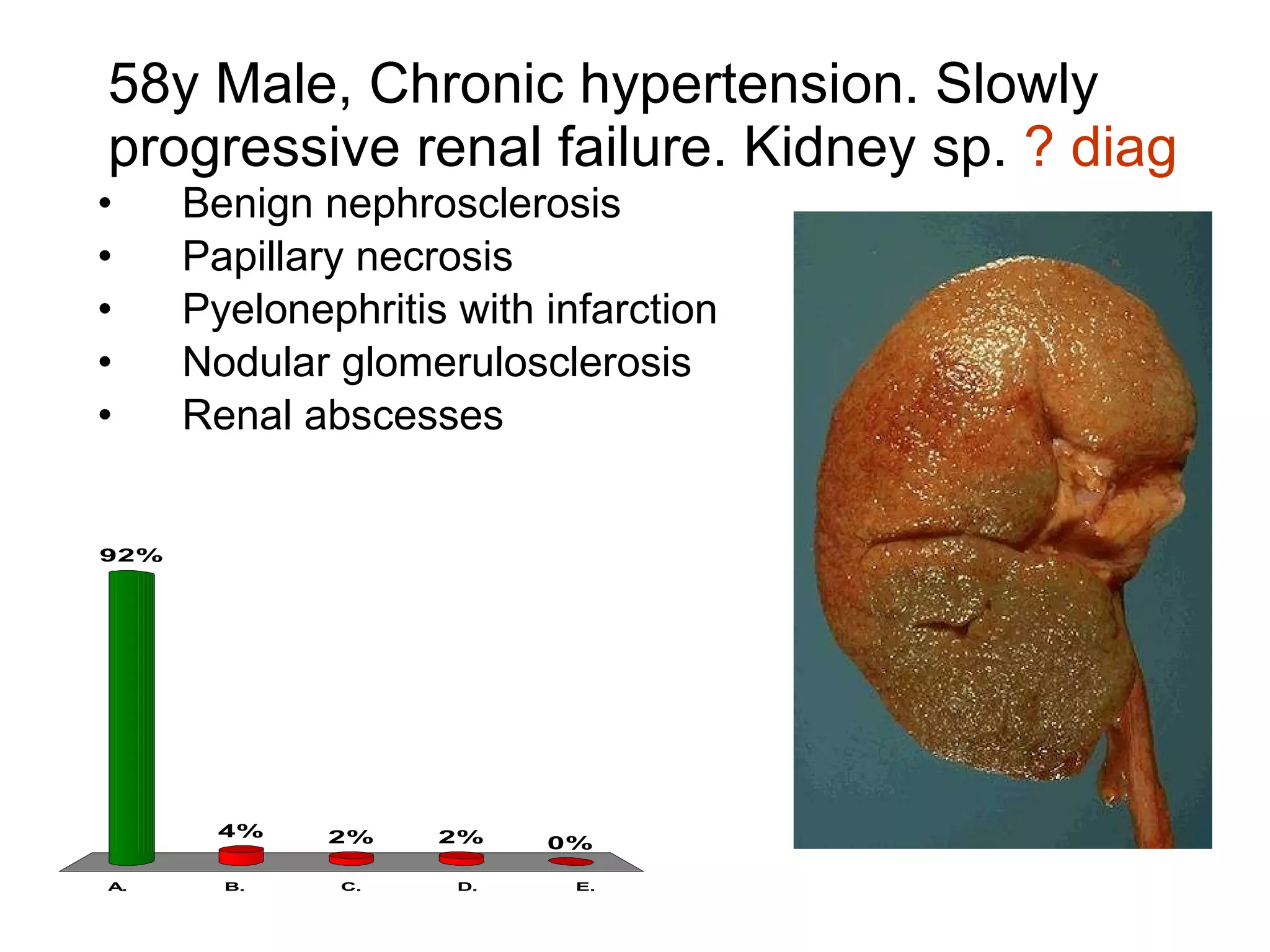 58y Male, Chronic hypertension. Slowly progressive renal failure. Kidney sp.  ? diag Benign nephrosclerosis Papillary necrosis Pyelonephritis with infarction Nodular glomerulosclerosis Renal abscesses 