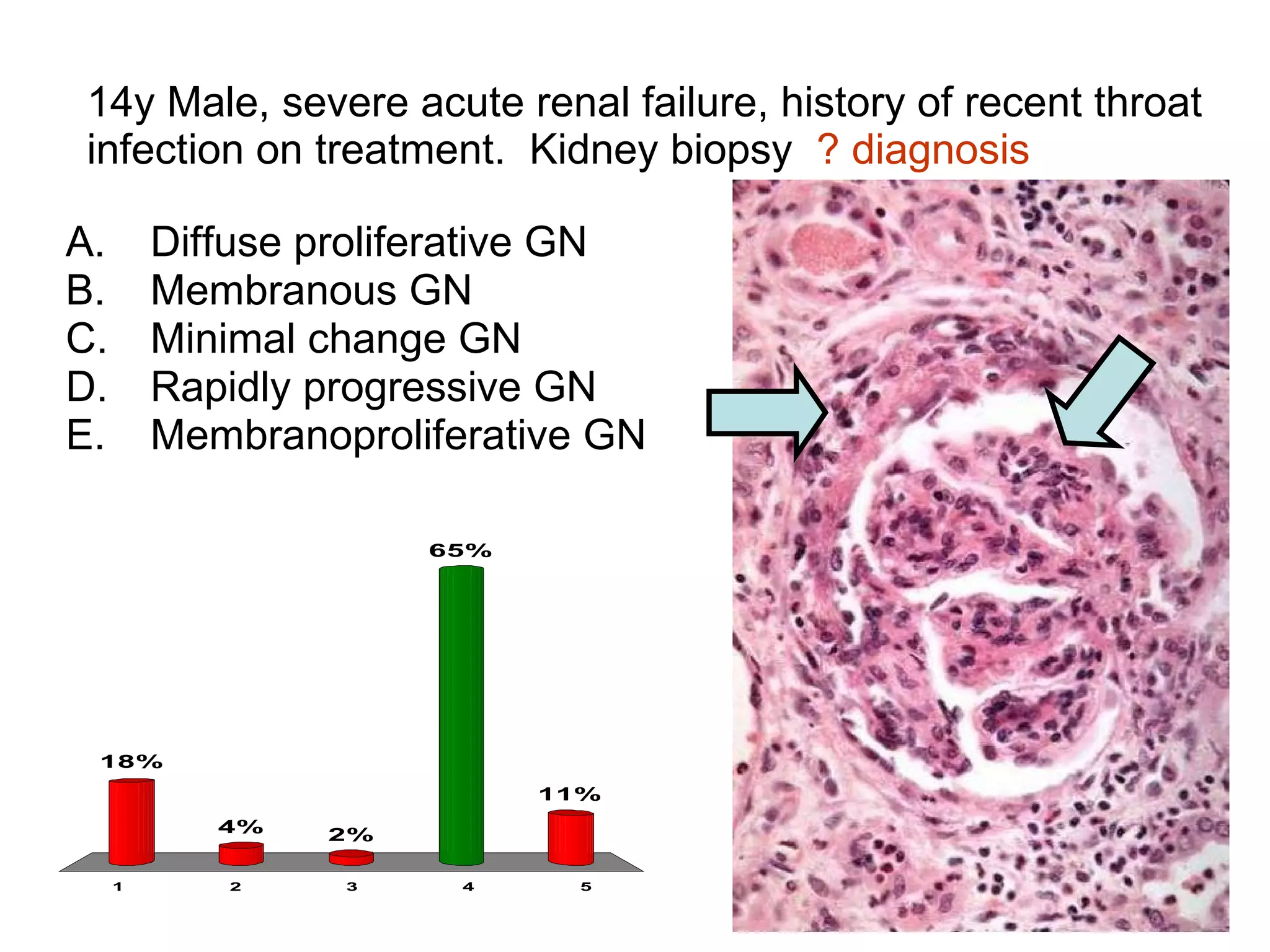 14y Male, severe acute renal failure, history of recent throat infection on treatment.  Kidney biopsy  ? diagnosis Diffuse proliferative GN Membranous GN Minimal change GN Rapidly progressive GN Membranoproliferative GN 