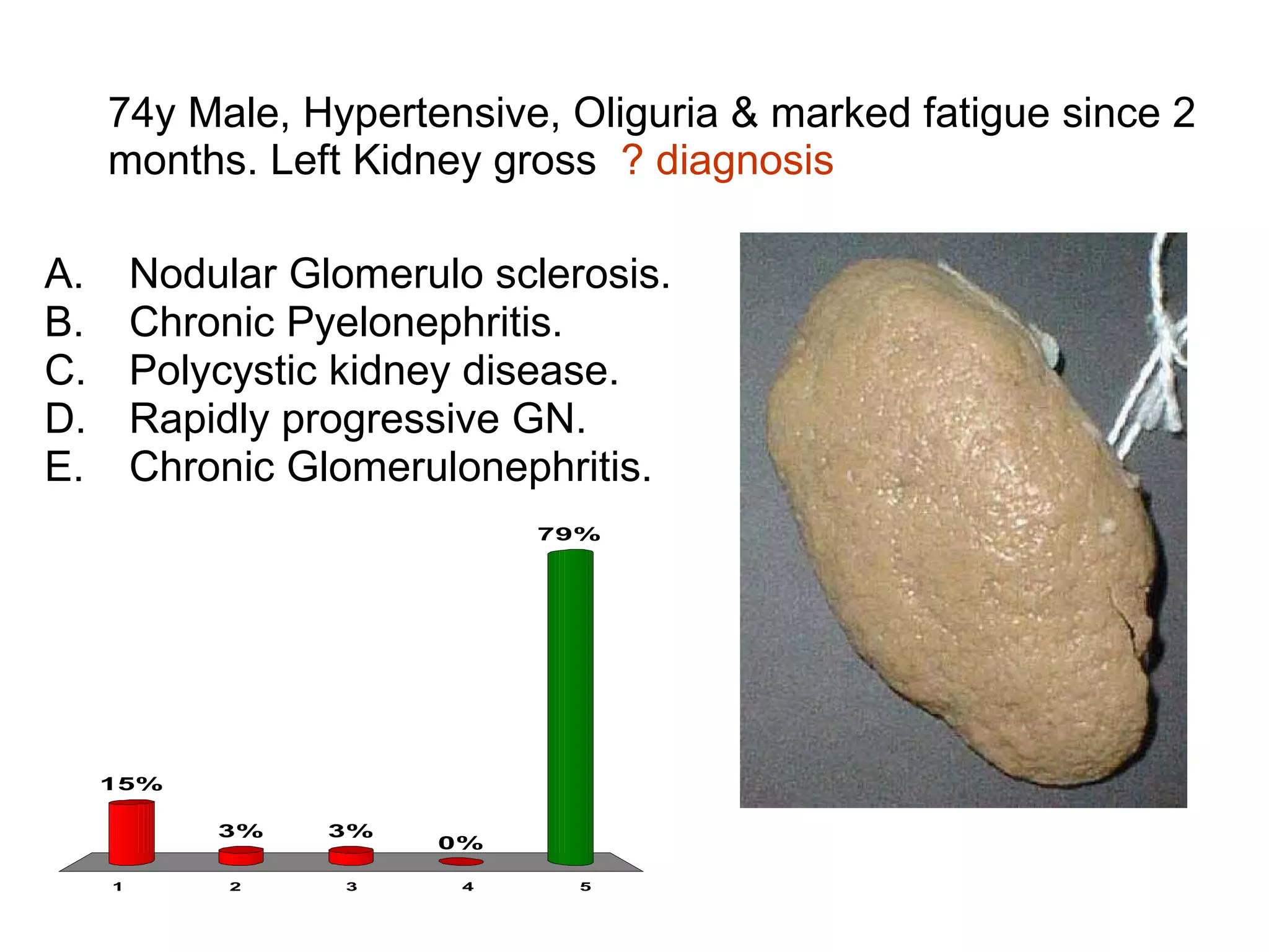 74y Male, Hypertensive, Oliguria & marked fatigue since 2 months. Left Kidney gross  ? diagnosis Nodular Glomerulo sclerosis. Chronic Pyelonephritis. Polycystic kidney disease. Rapidly progressive GN. Chronic Glomerulonephritis. 